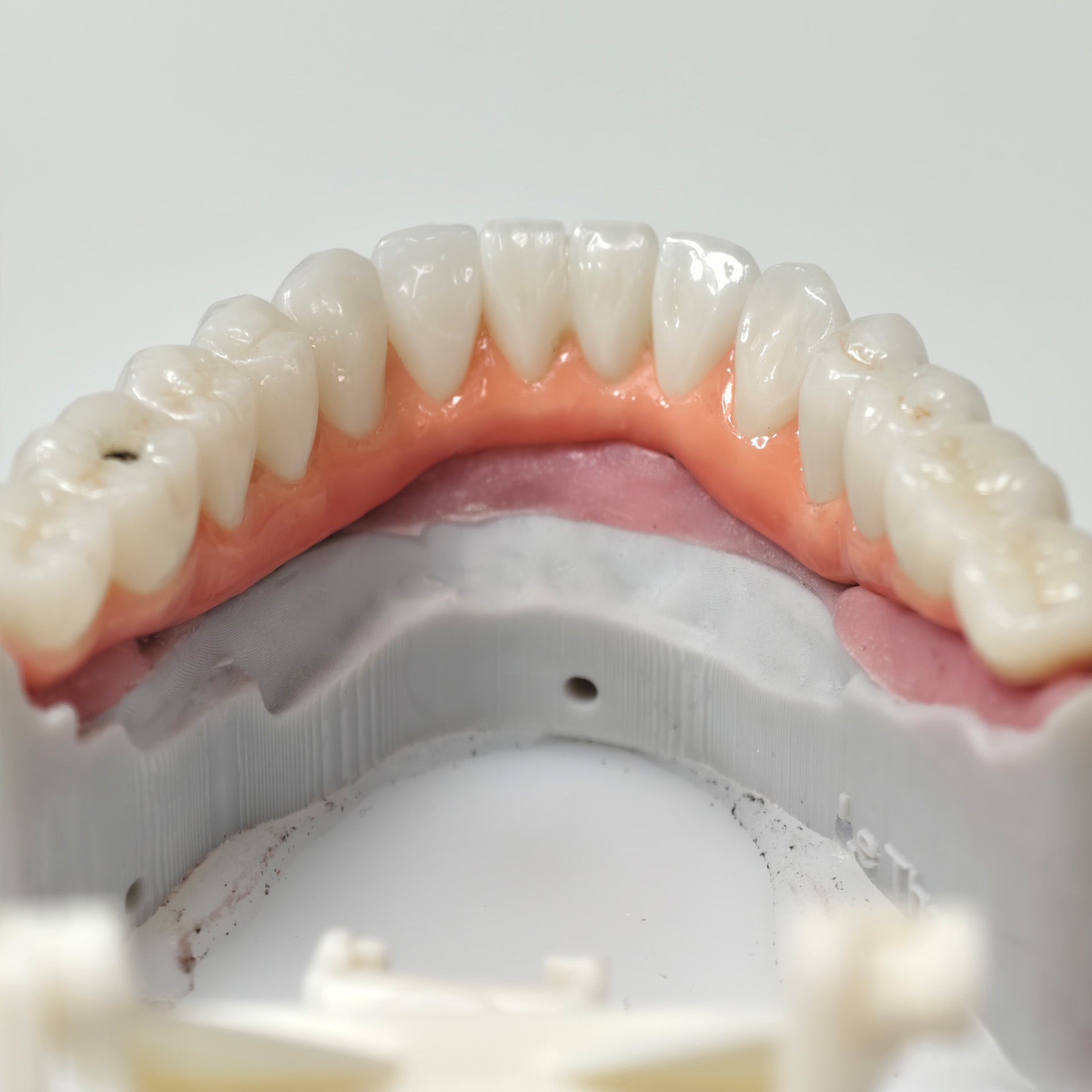 Zirconia-Enamel Hybrid Malo Bridge