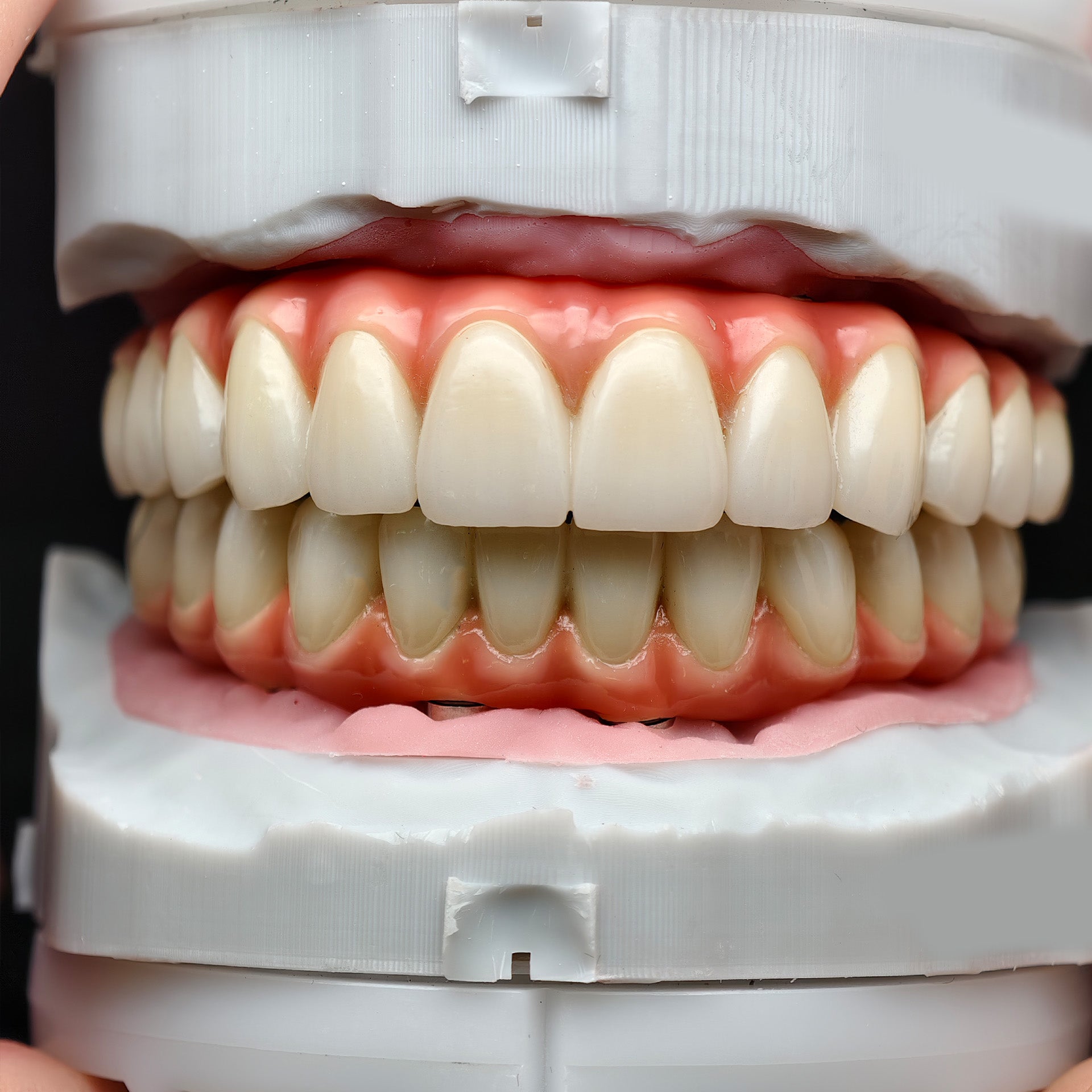 Zirconia-Enamel Hybrid Malo Bridge