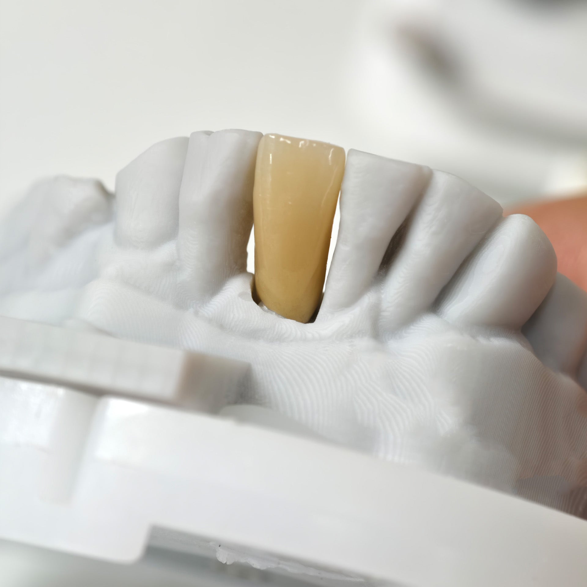 Zirconia Implant Bridge Screwmentable Dental Crown