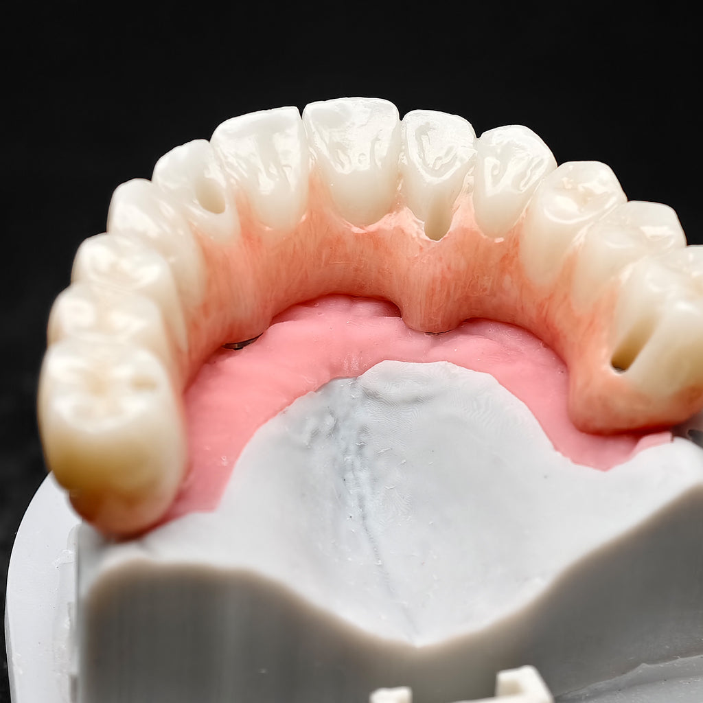 All On 4 Zirconia Bridge With Ti-Base Screw Retained Trying For Full Arch Restoration