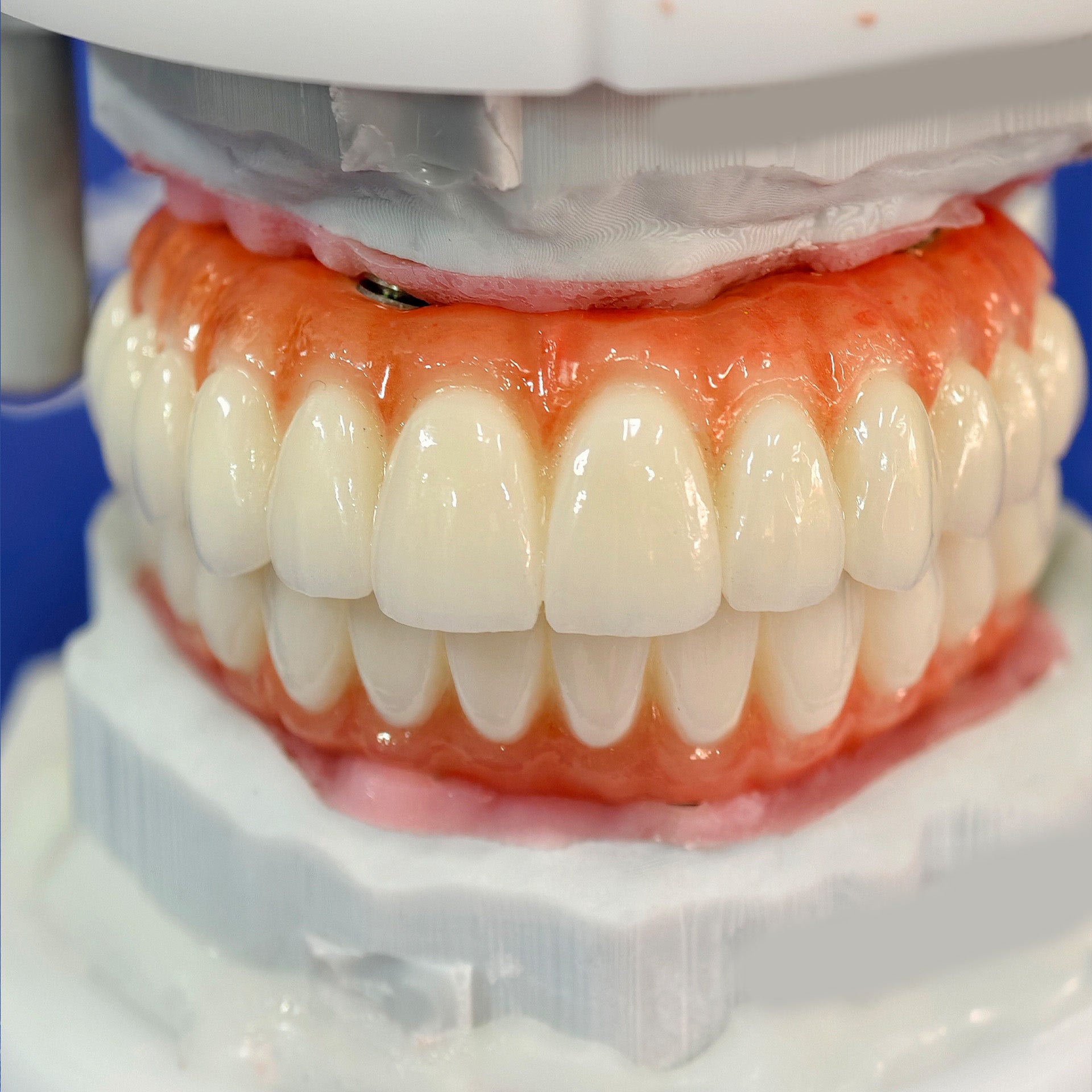 All On 4 Zirconia Bridge With Ti-Base Screw Retained Trying For Full Arch Restoration