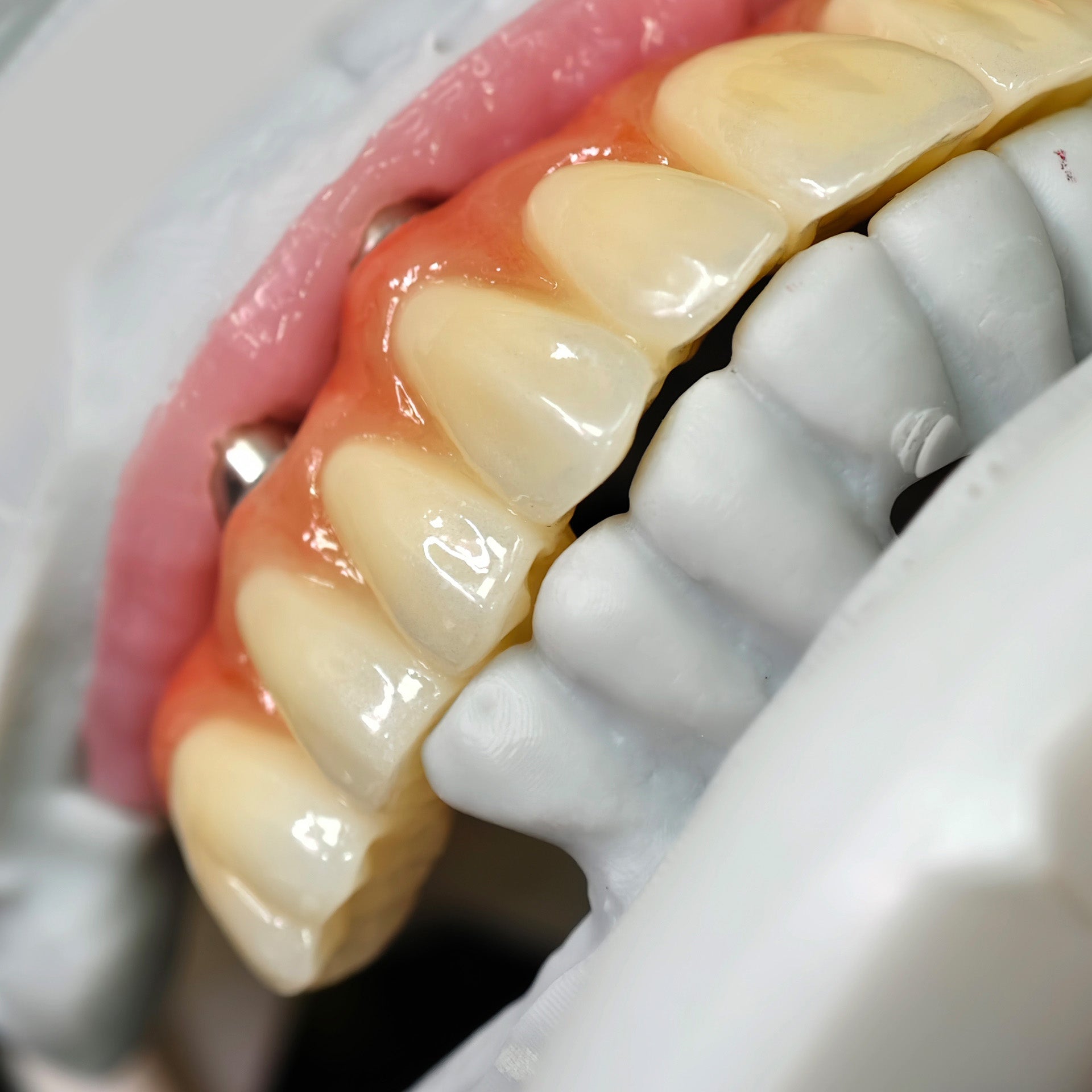 All On 5 Zirconia Bridge With Ti-Base Screw Retained Trying For Full Arch Restoration