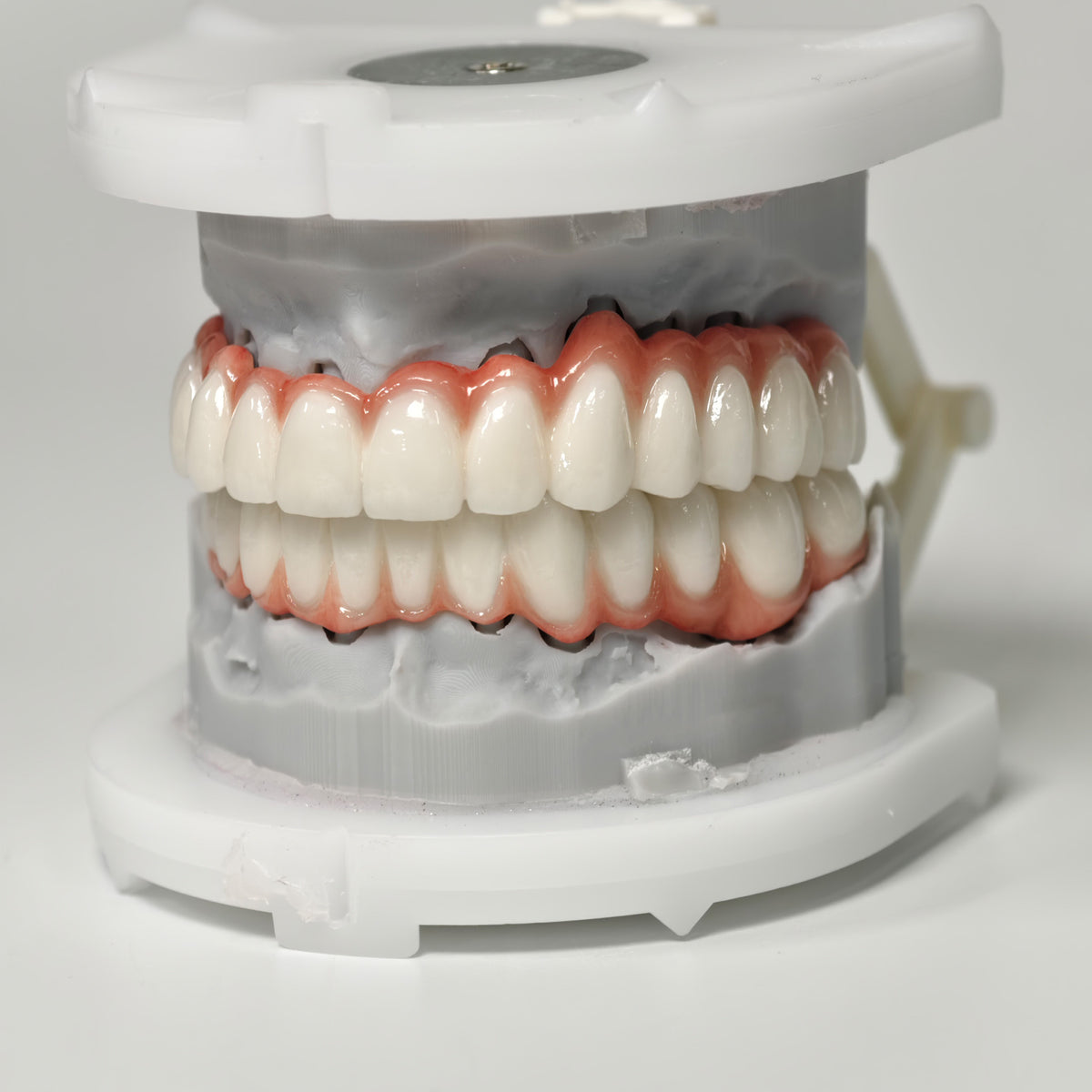 Full-Arch PFM Bridge With Screw Retained