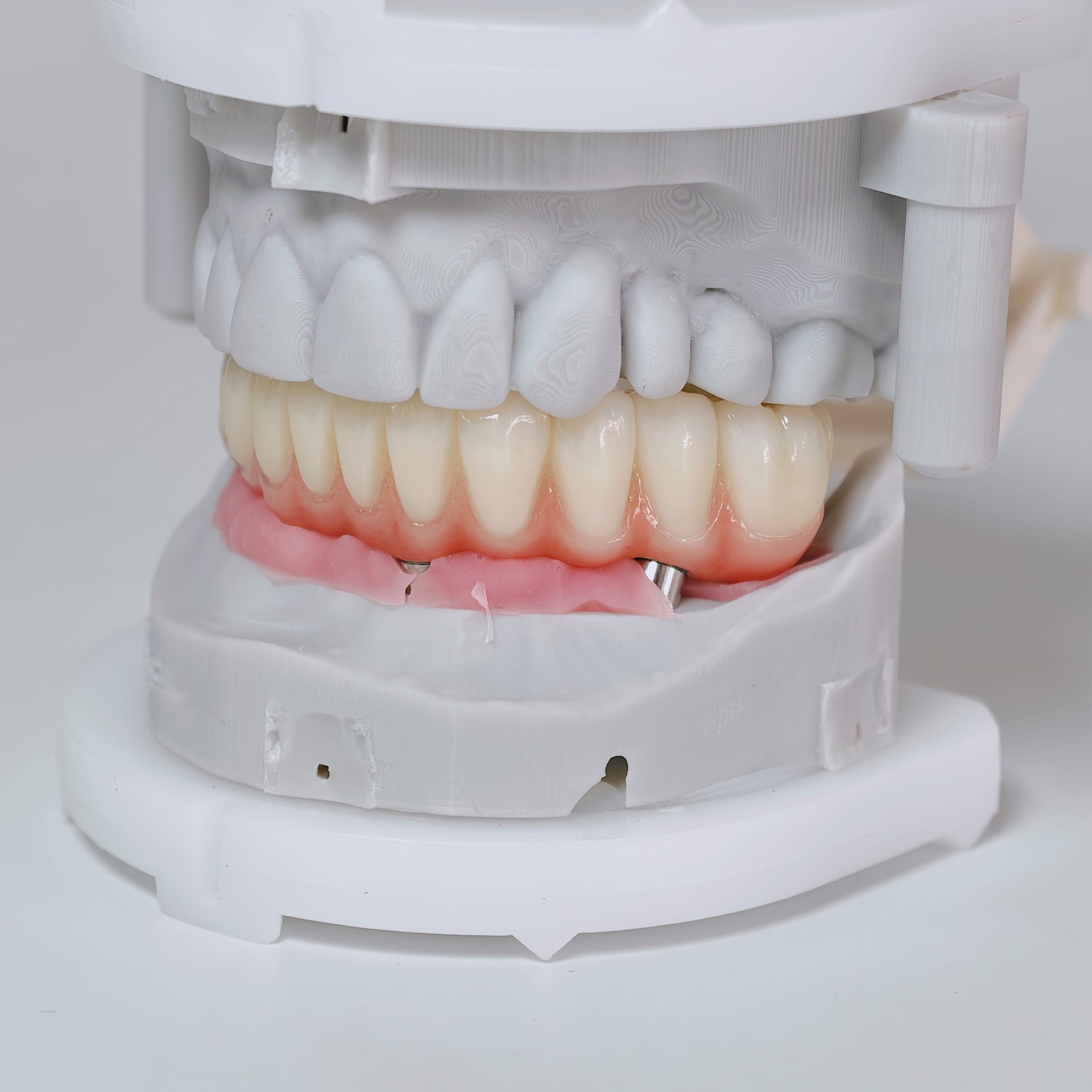 All On 4 Zirconia Bridge With Ti-Base Screw Retained