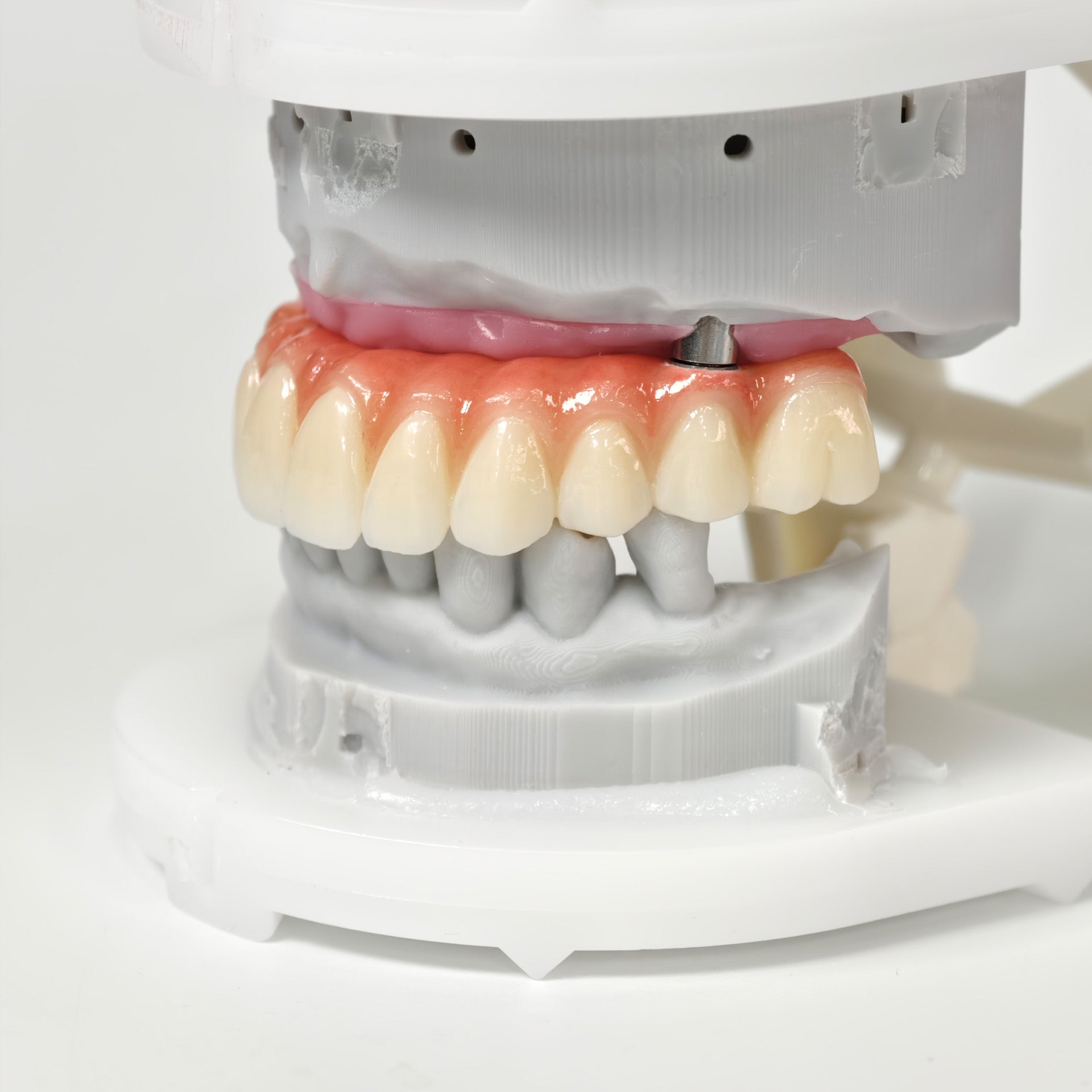 All On 5 Zirconia Bridge With Ti-Base Screw Retained