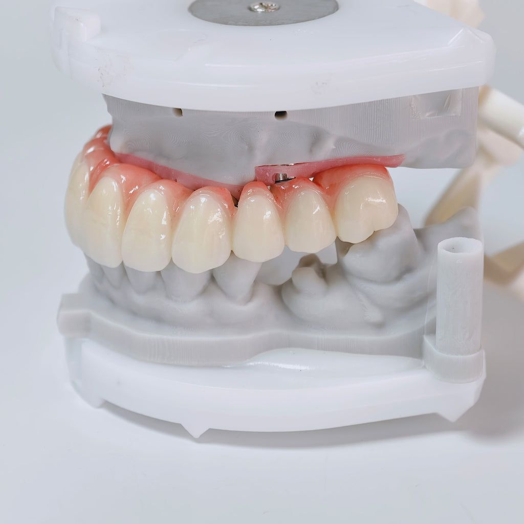 All On 6 Zirconia Bridge With Ti-Base Screw Retained