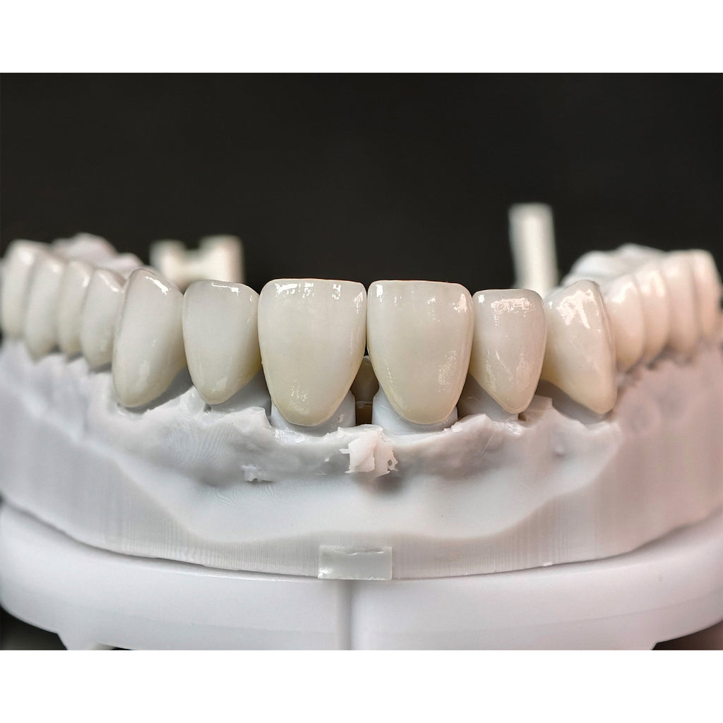 Ceramic Veneers And Crown With Cement Retained