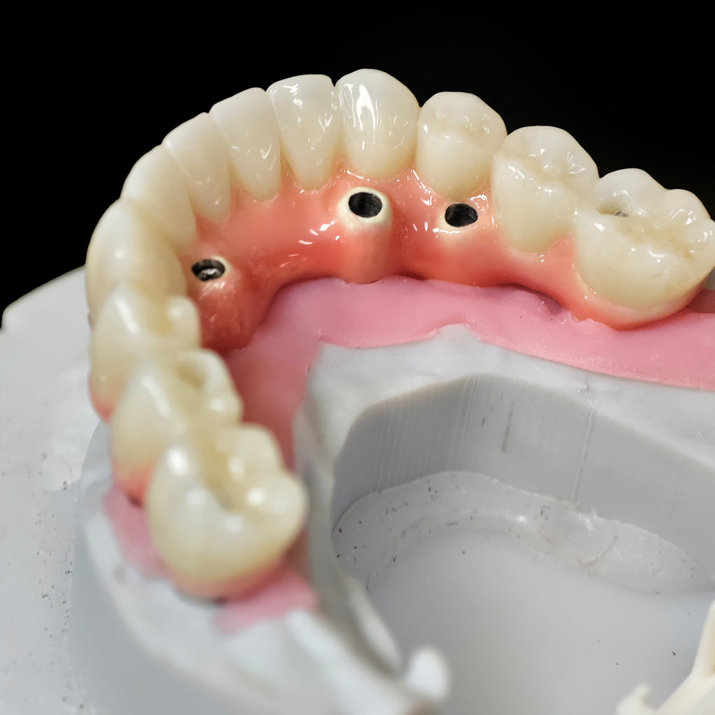 Enhanced Zirconia Crown Malo Bridge