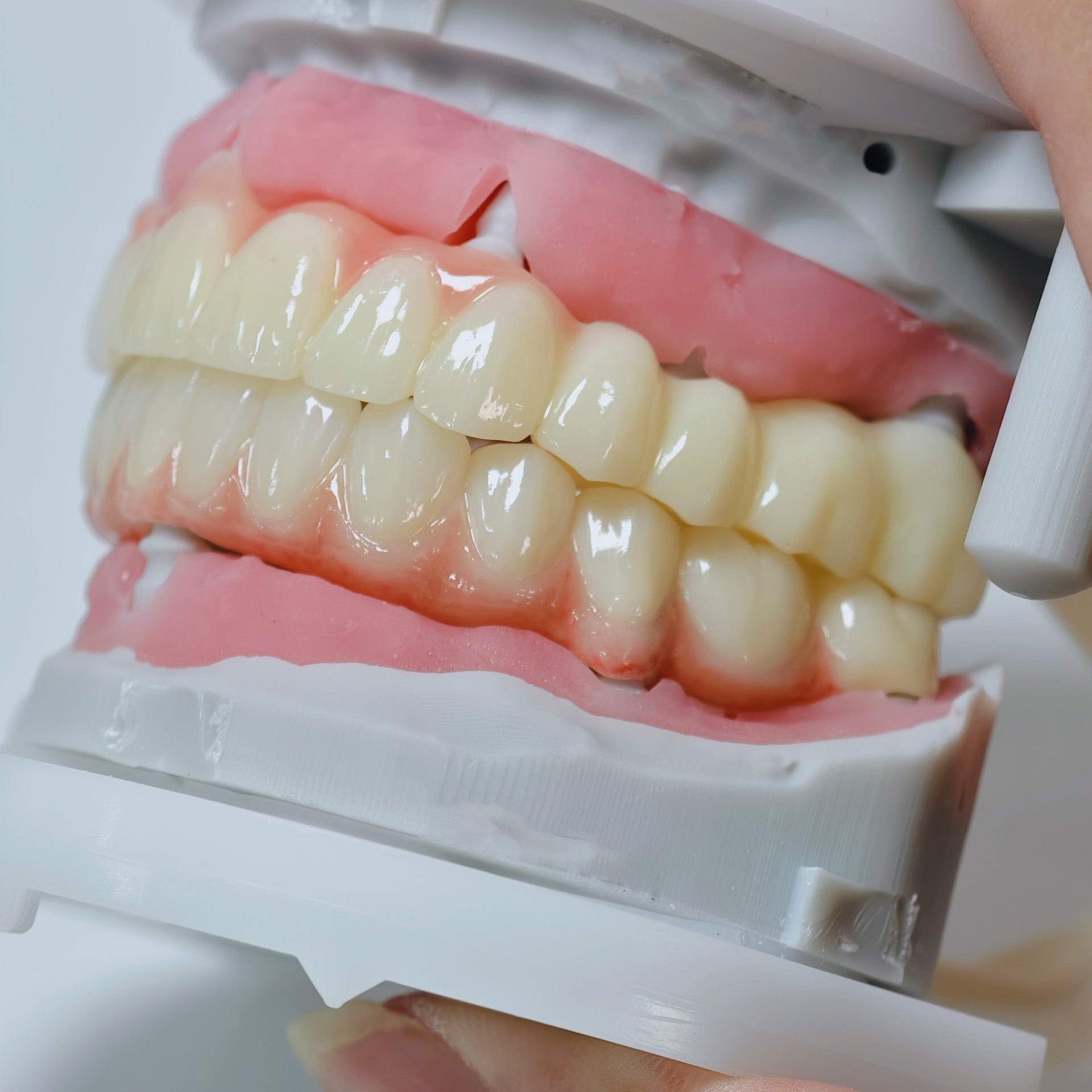 Full-Arch Zirconia Bridge And PMMA Bridge With Cement Retained