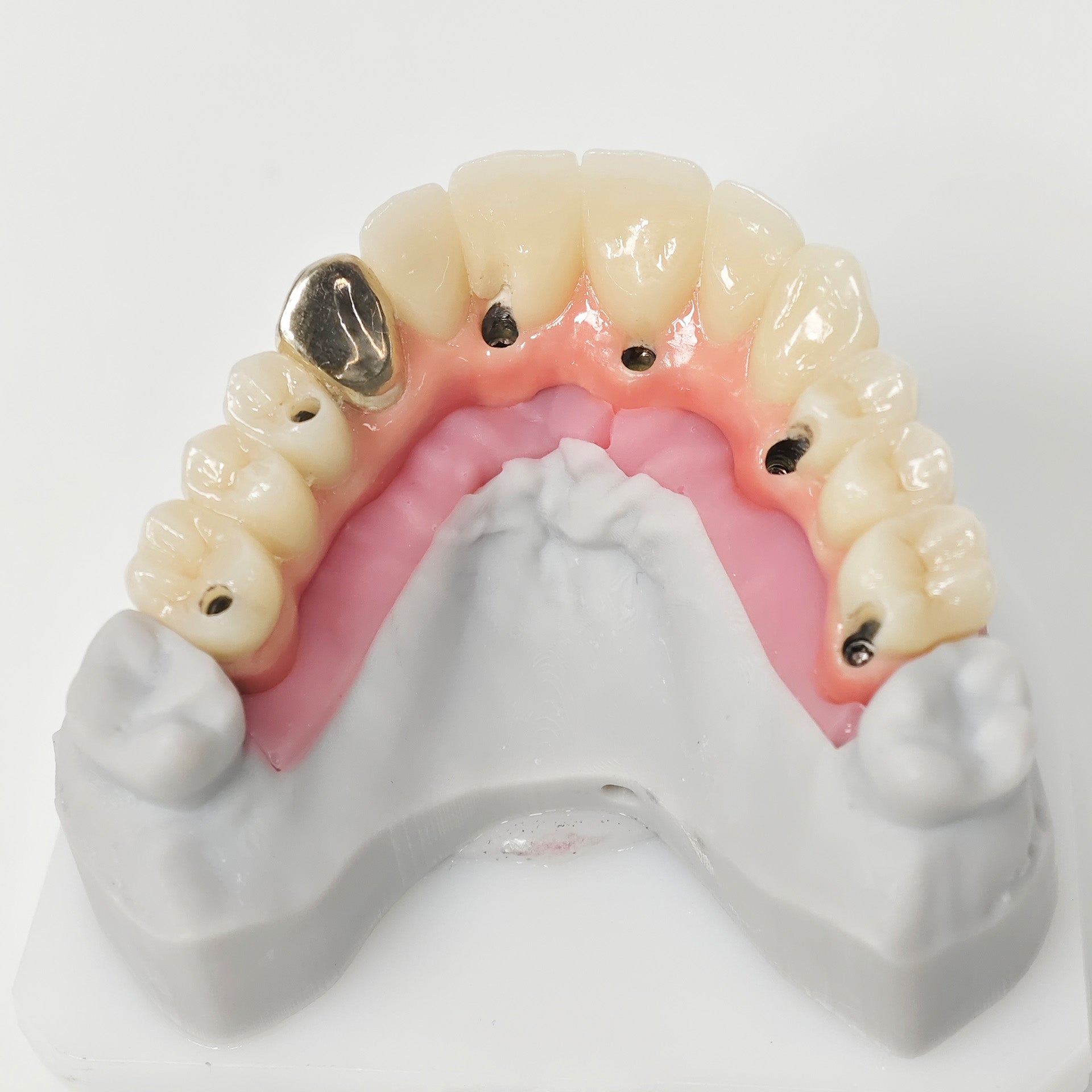 Malo Bridge With Gold-Plated Titanium Framework And A Gold Crown