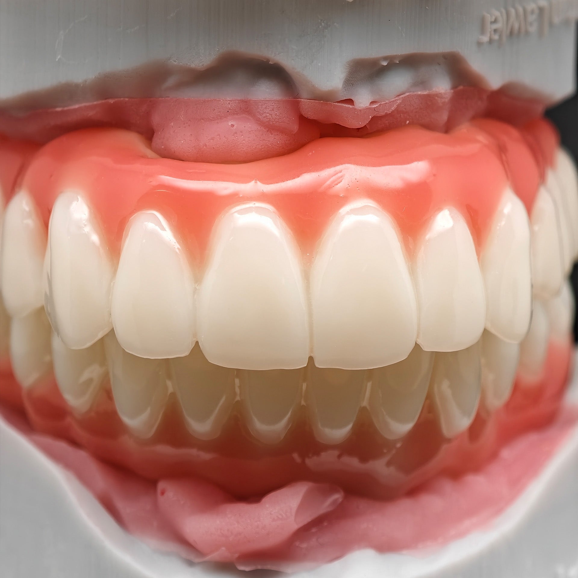 PMMA Bridge With Ti-Base Screw Retained Trying For Full Arch Restoration