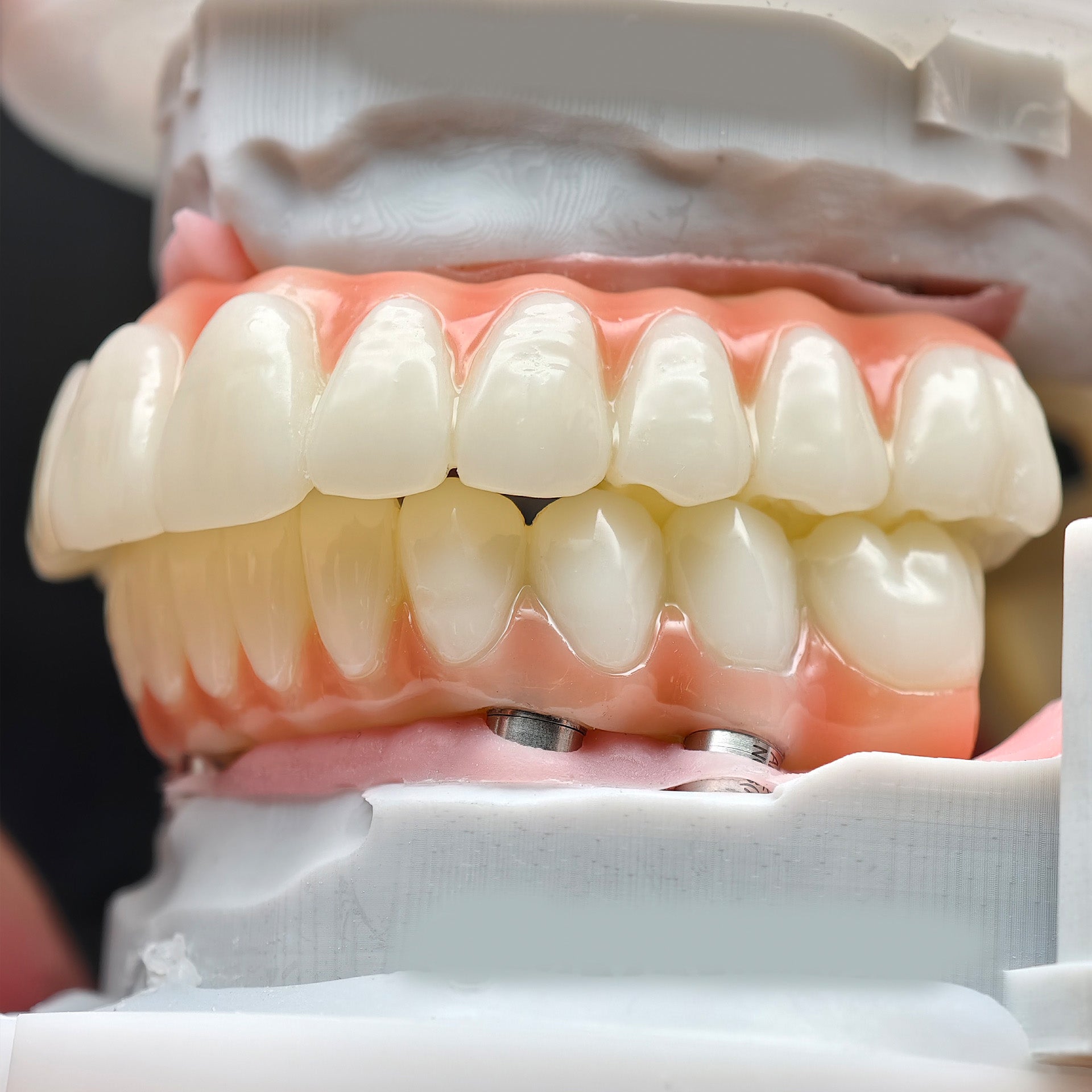 PMMA Bridge With Ti-Base Screw Retained Trying For Full Arch Restoration