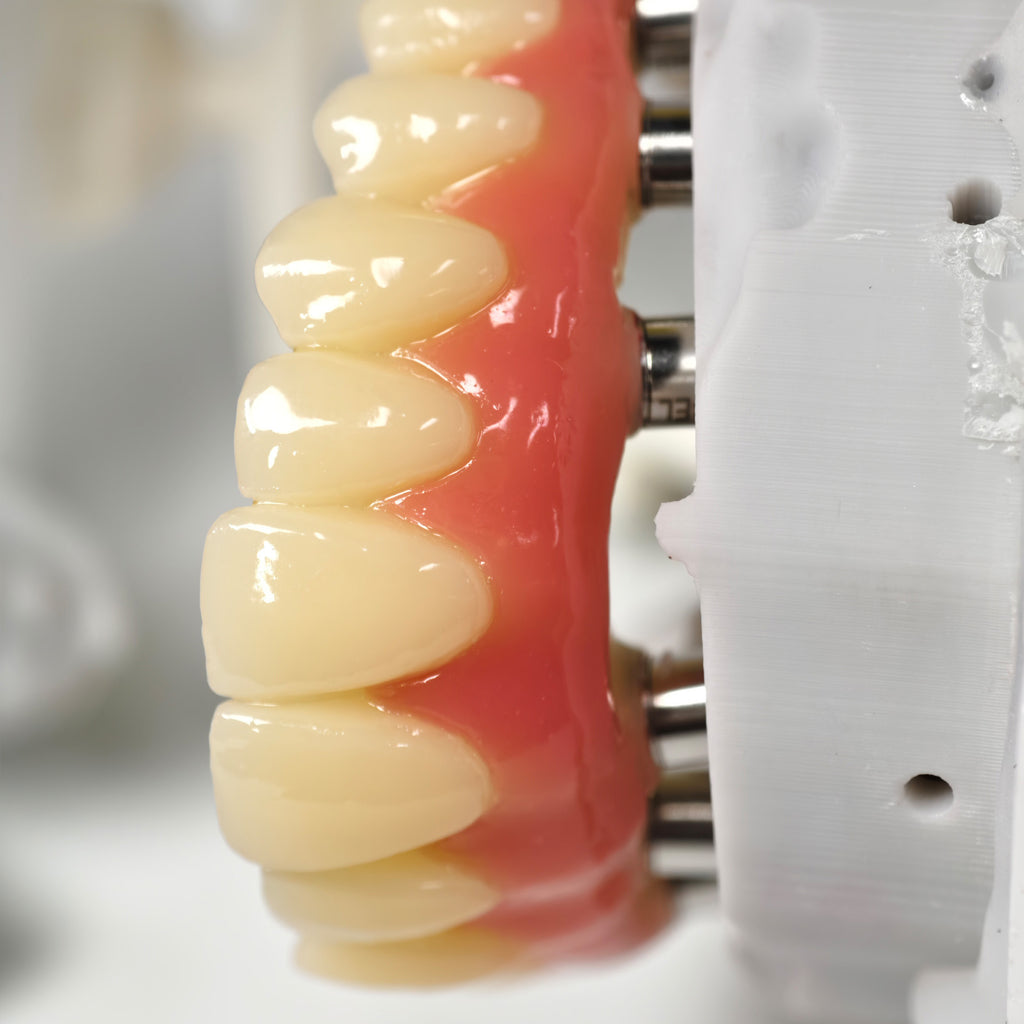 PMMA Bridge With Screw Retained