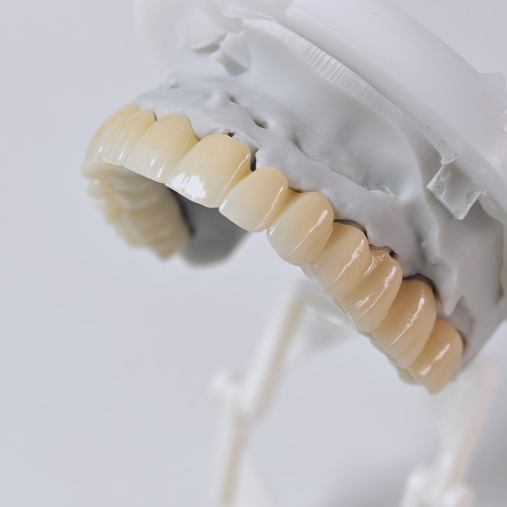 Ti-Bar Titanium Nitride Metal Frame With Zirconia Bridge And Cement Retained