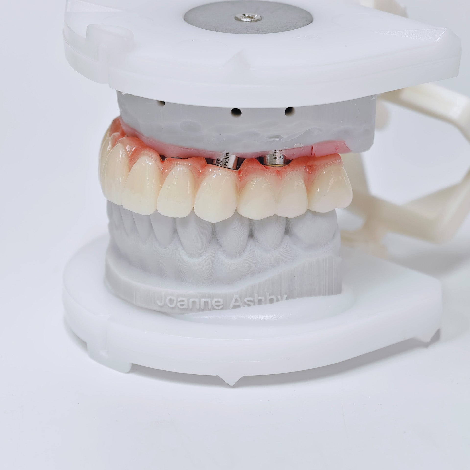 Ti-Bar Titanium Nitride Metal Frame With Zirconia Bridge For Full Arch Restoration