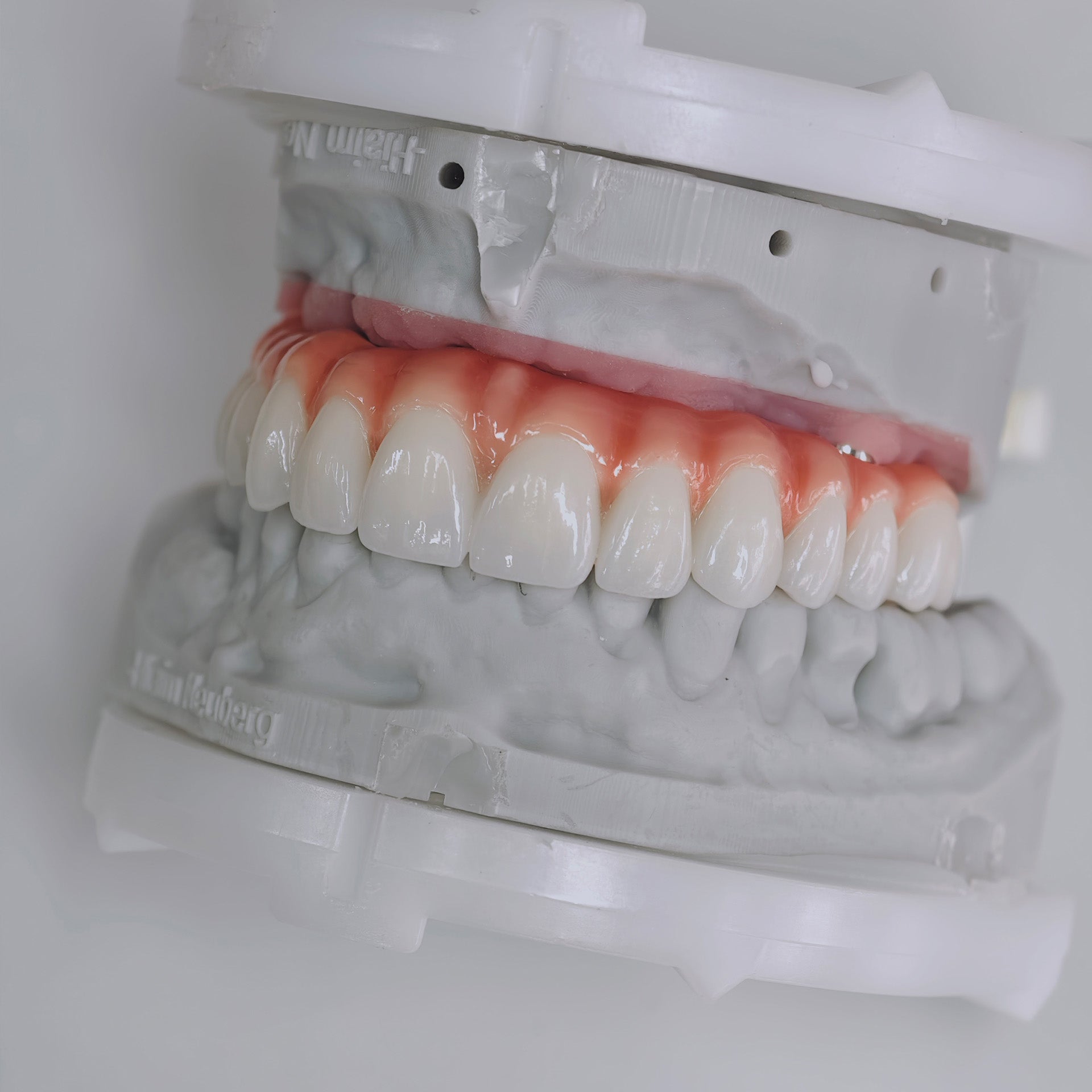 Zirconia-Enamel Hybrid Malo Bridge Aesthetic