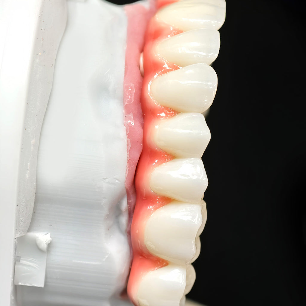Zirconia-Enamel Hybrid Malo Bridge