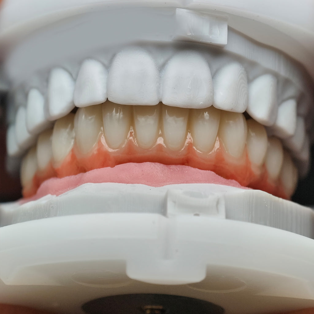 Zirconia Bridge With Cement Retained