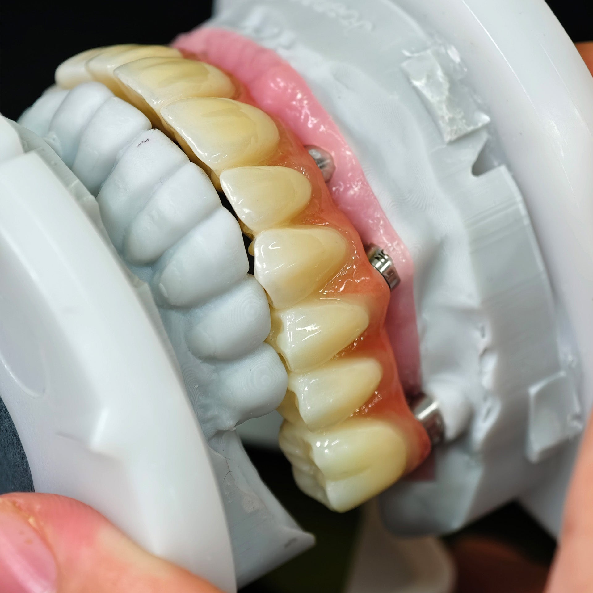 All On 5 Zirconia Bridge With Ti-Base Screw Retained Trying For Full Arch Restoration