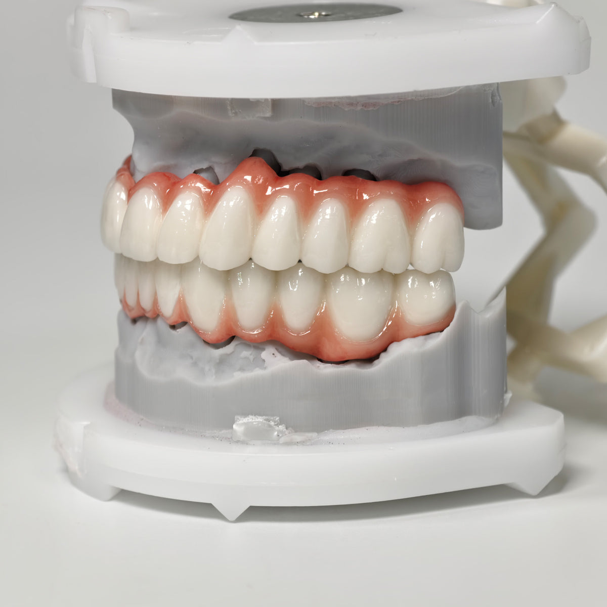 Full-Arch PFM Bridge With Screw Retained