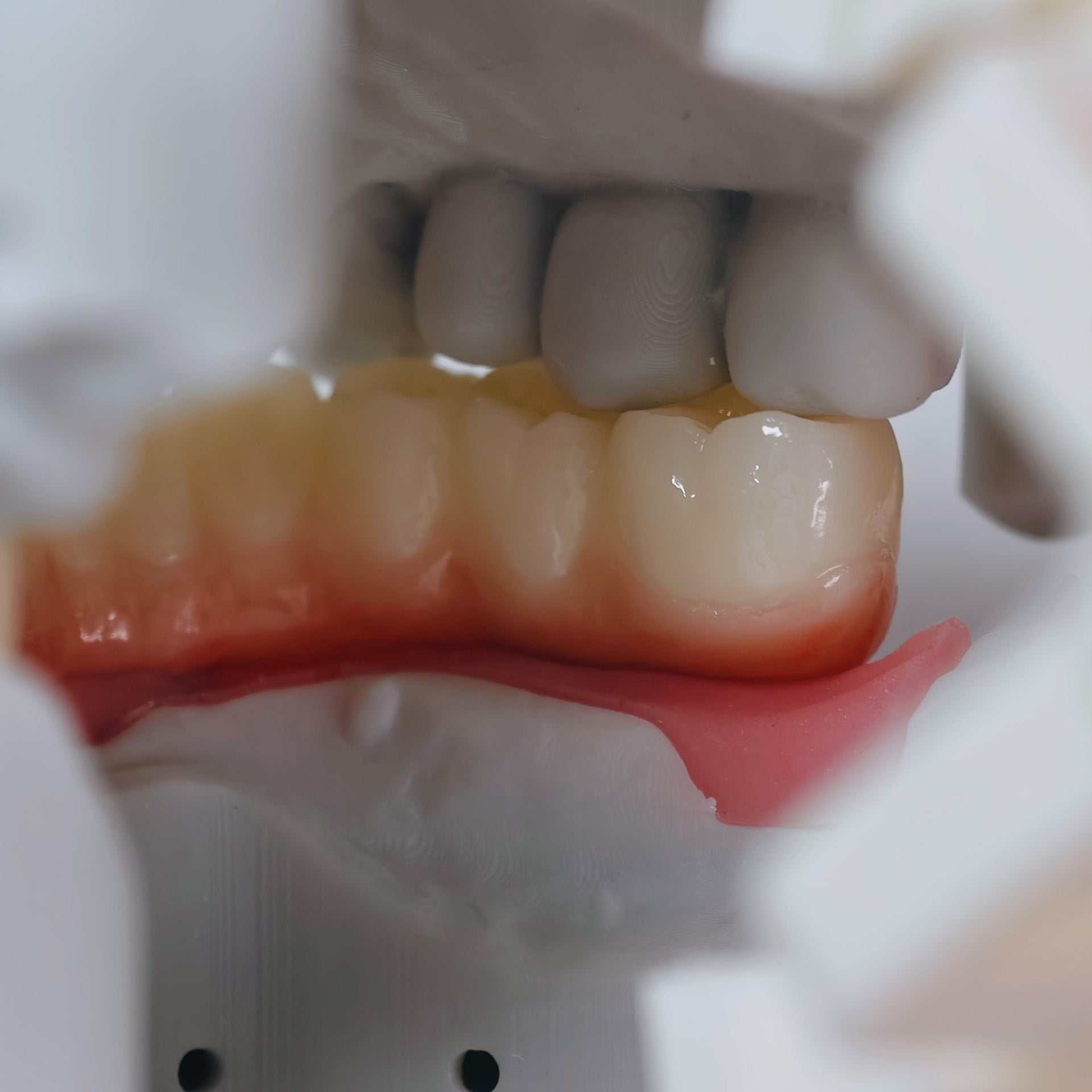 All On 4 Zirconia Bridge With Ti-Base Screw Retained