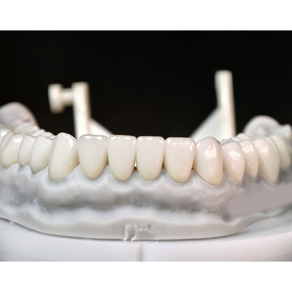 Ceramic Veneers And Crown With Cement Retained