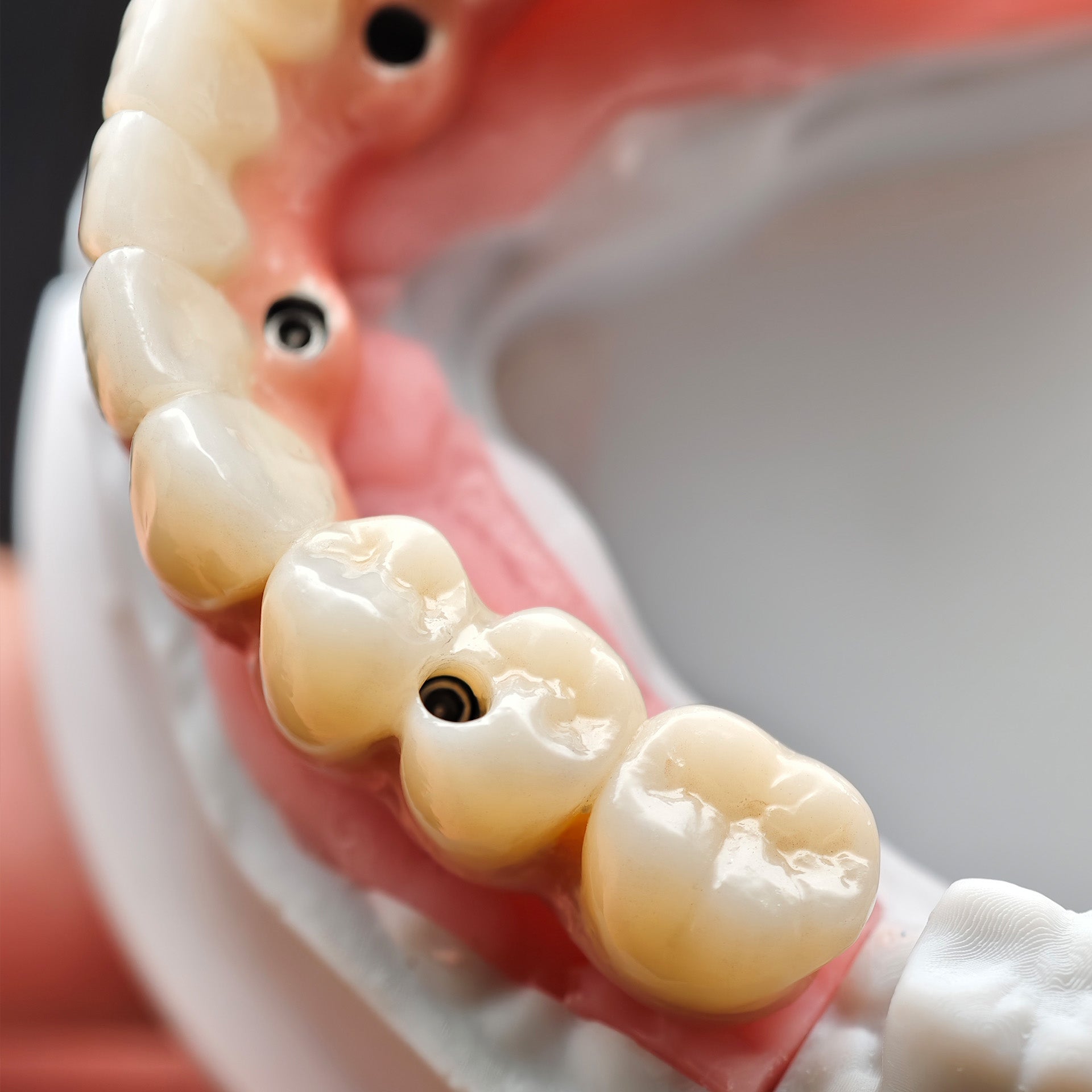 Enhanced Zirconia Crown Malo Bridge