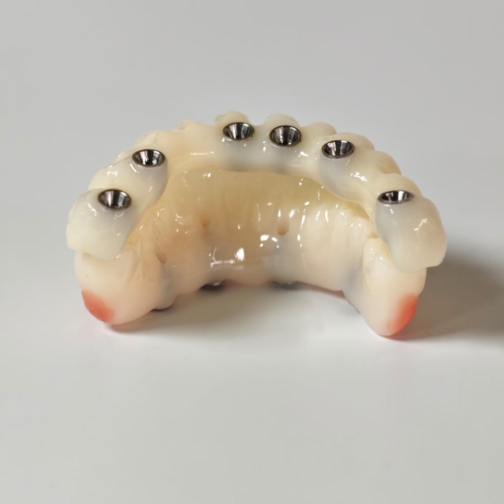 Full-Arch PMMA Bridge With Ti-Base Screw Retained