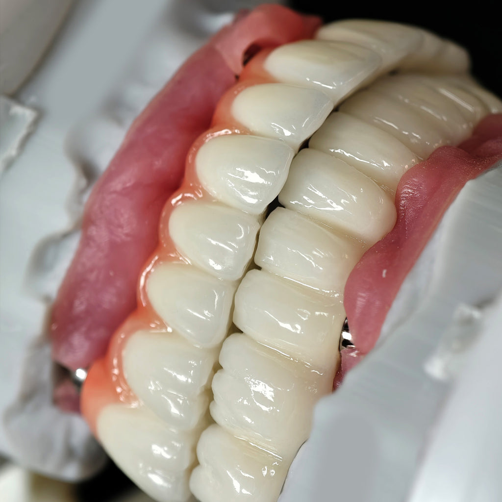 Implant-supported Co - Cr PFM Dental Bridge