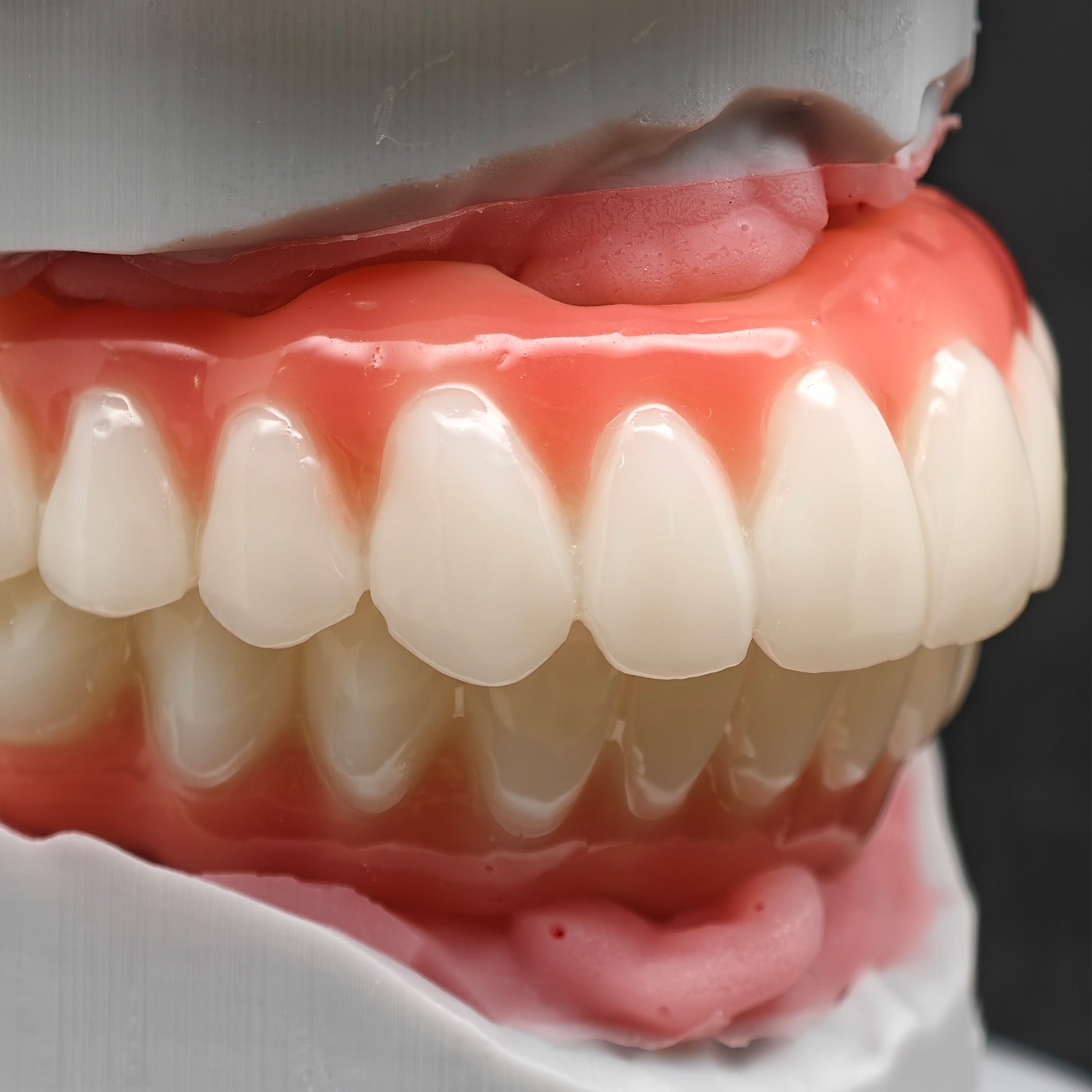 PMMA Bridge With Ti-Base Screw Retained Trying For Full Arch Restoration