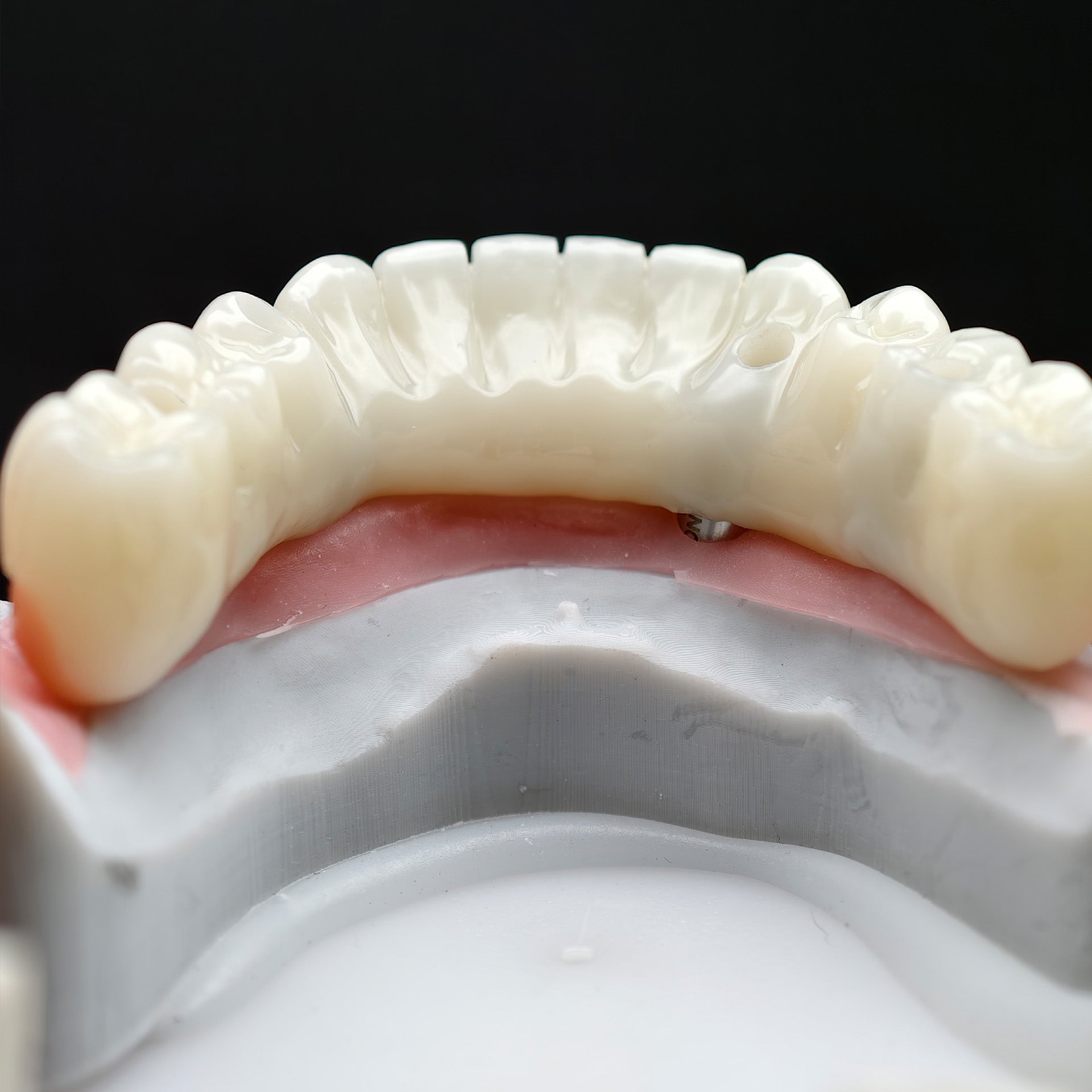 PMMA Bridge With Ti-Base Screw Retained Trying For Full Arch Restoration