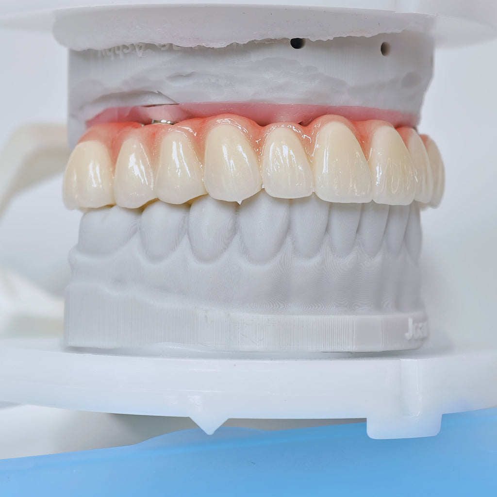 Ti-Bar Titanium Nitride Metal Frame With Zirconia Bridge For Full Arch Restoration