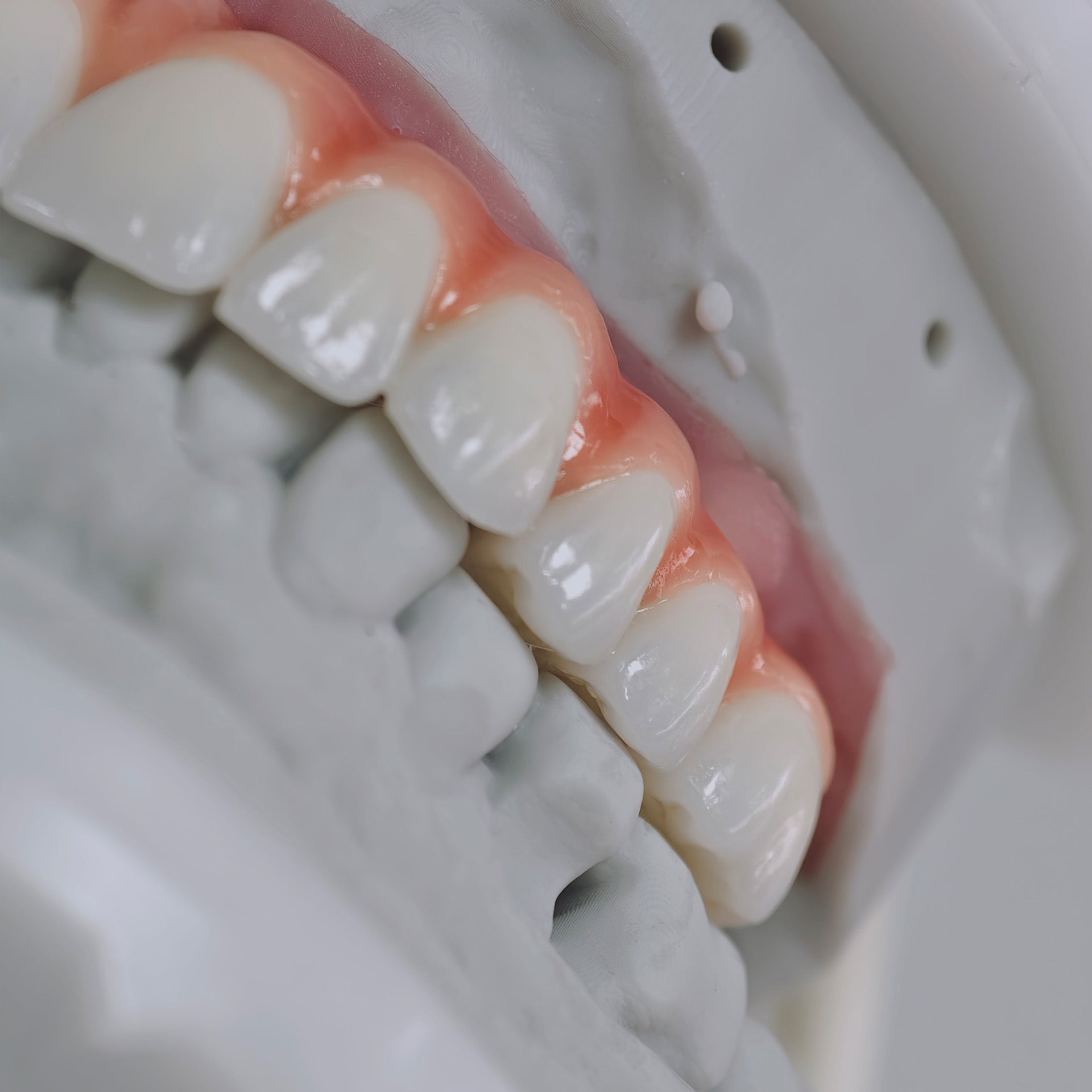Zirconia-Enamel Hybrid Malo Bridge Aesthetic