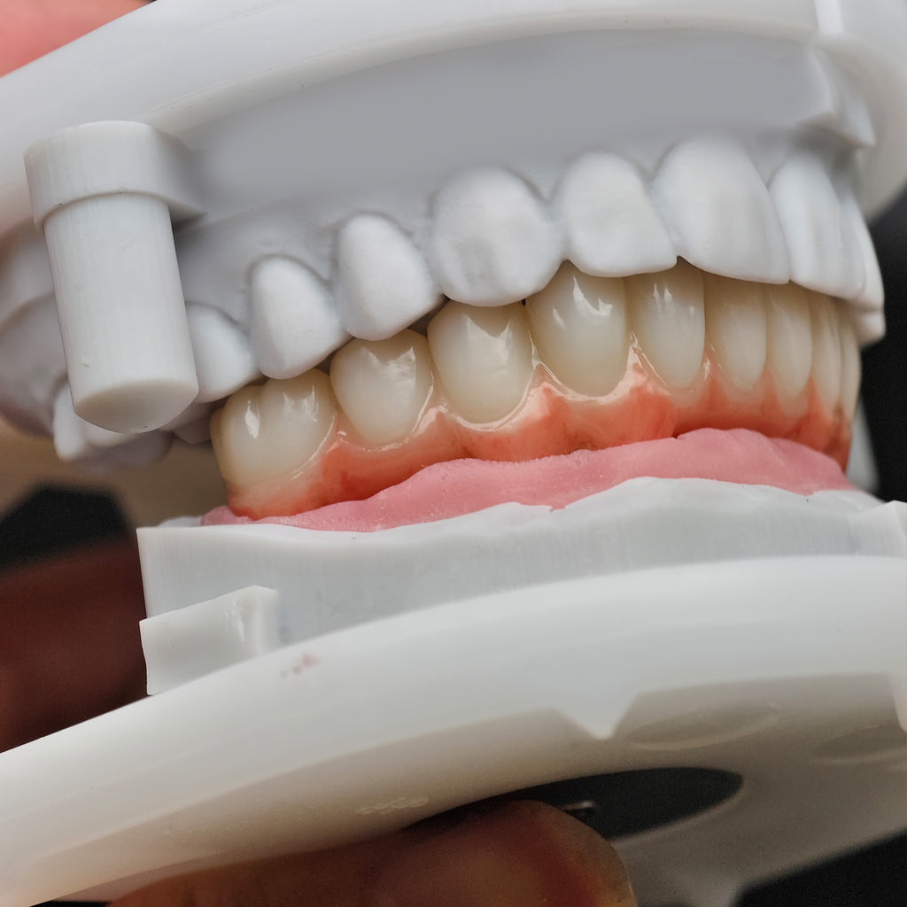 Zirconia Bridge With Cement Retained