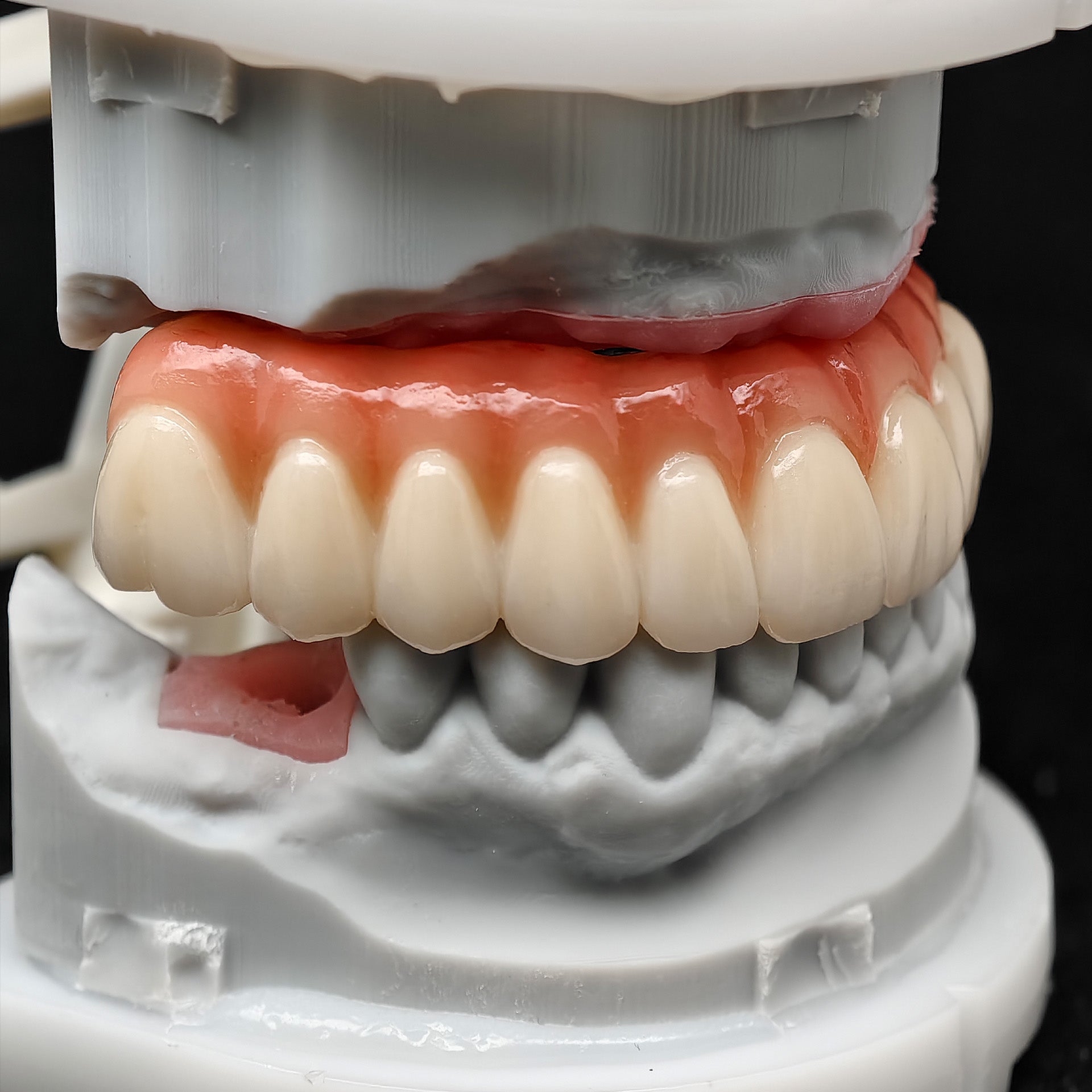 All On 4 Zirconia Bridge With Ti-Base Screw Retained Trying For Full Arch Restoration