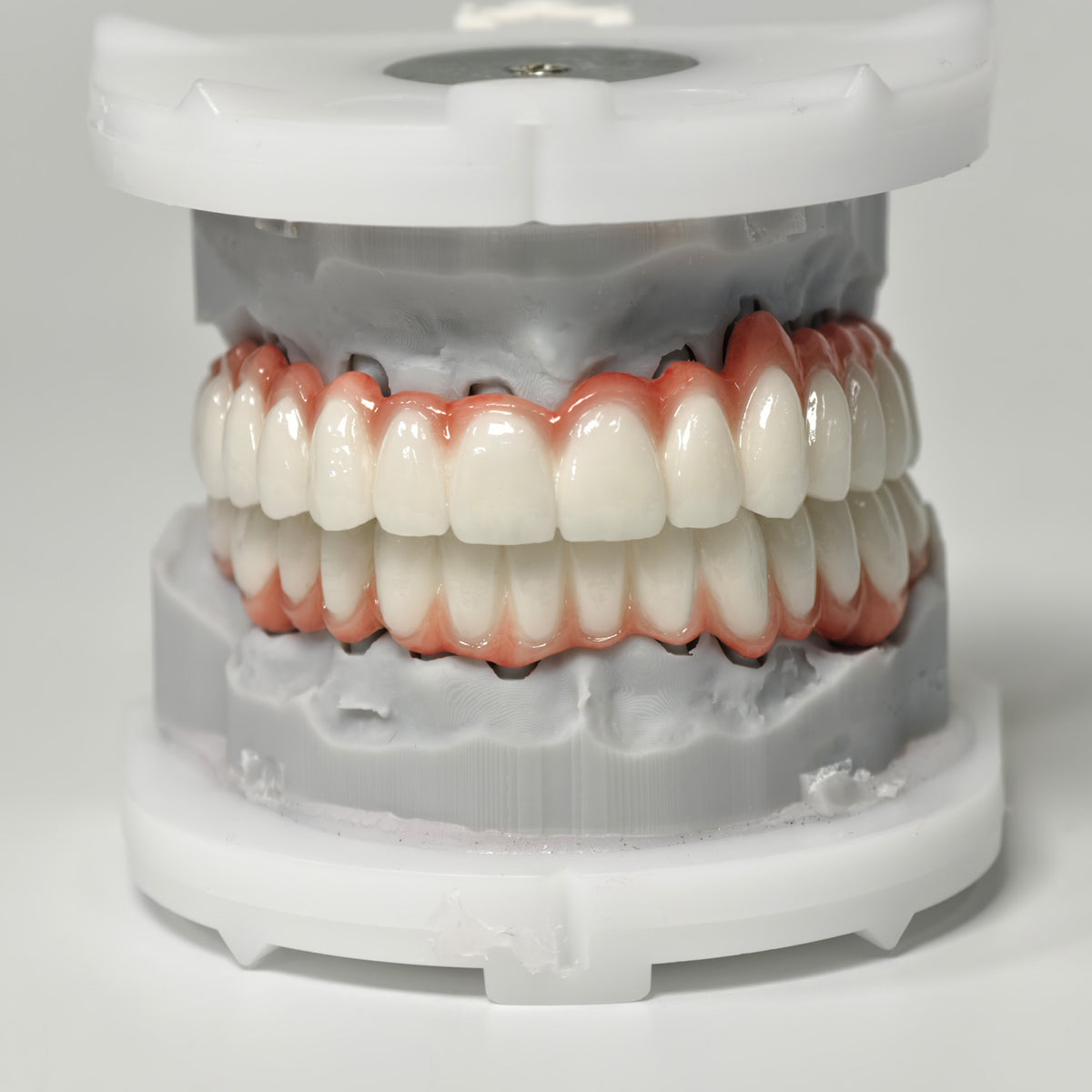 Full-Arch PFM Bridge With Screw Retained