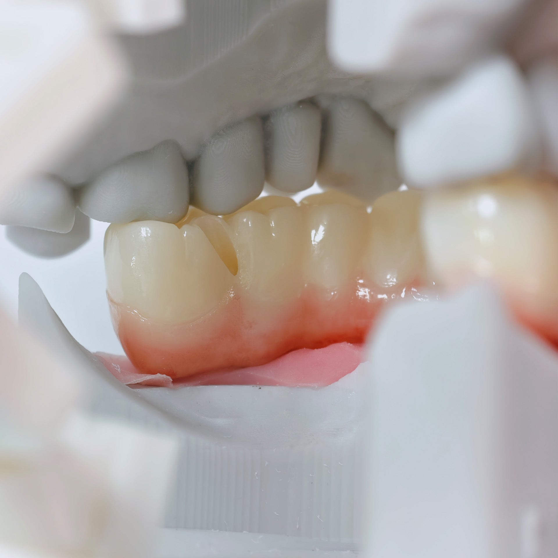 All On 4 Zirconia Bridge With Ti-Base Screw Retained