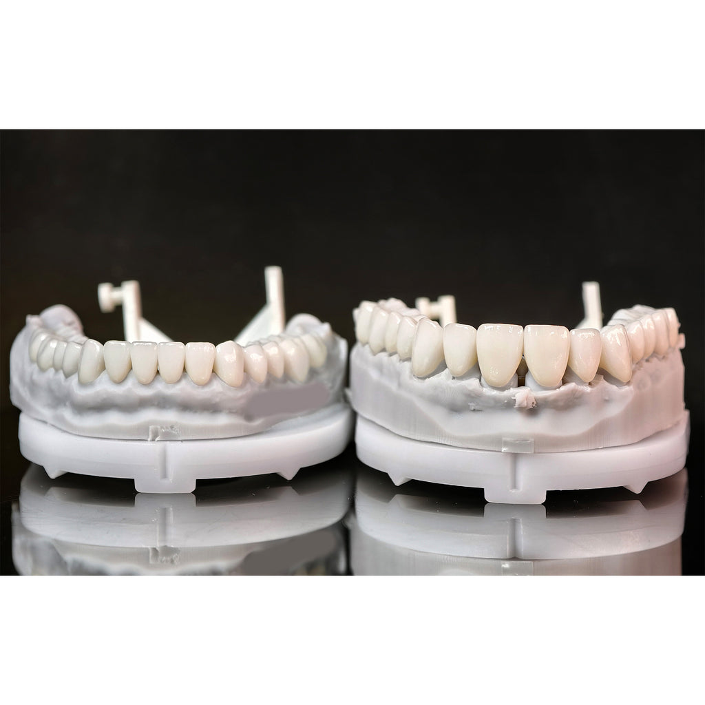 Ceramic Veneers And Crown With Cement Retained