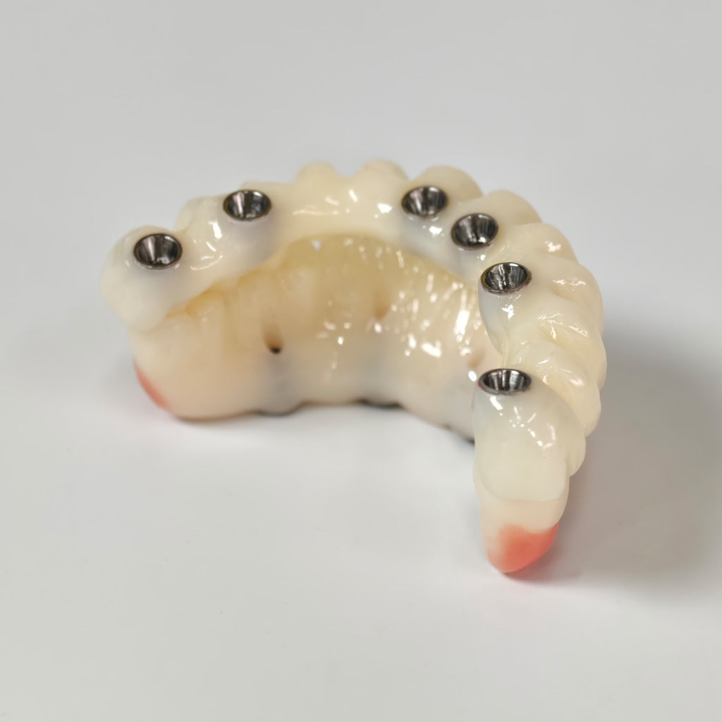 Full-Arch PMMA Bridge With Ti-Base Screw Retained