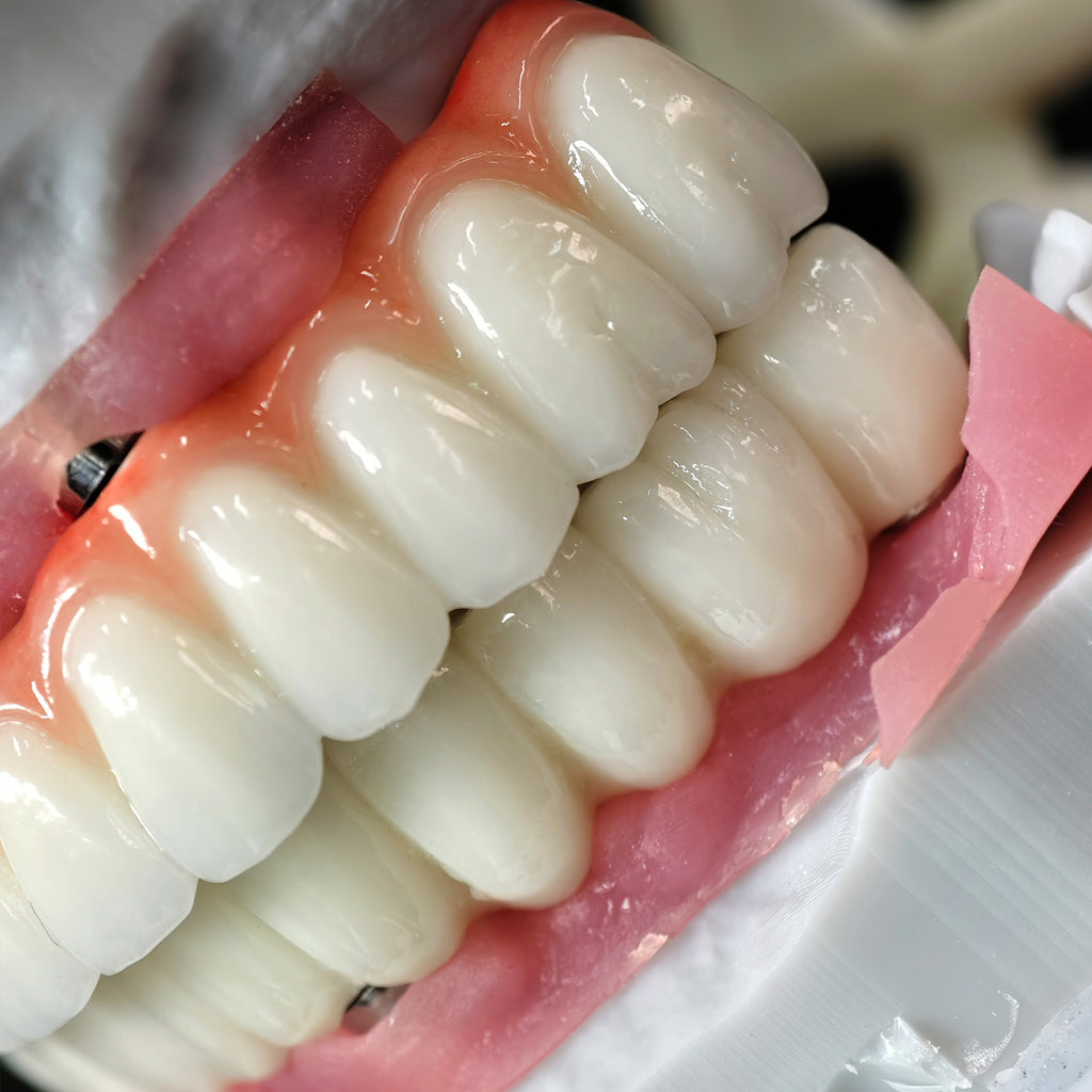 Implant-supported Co - Cr PFM Dental Bridge
