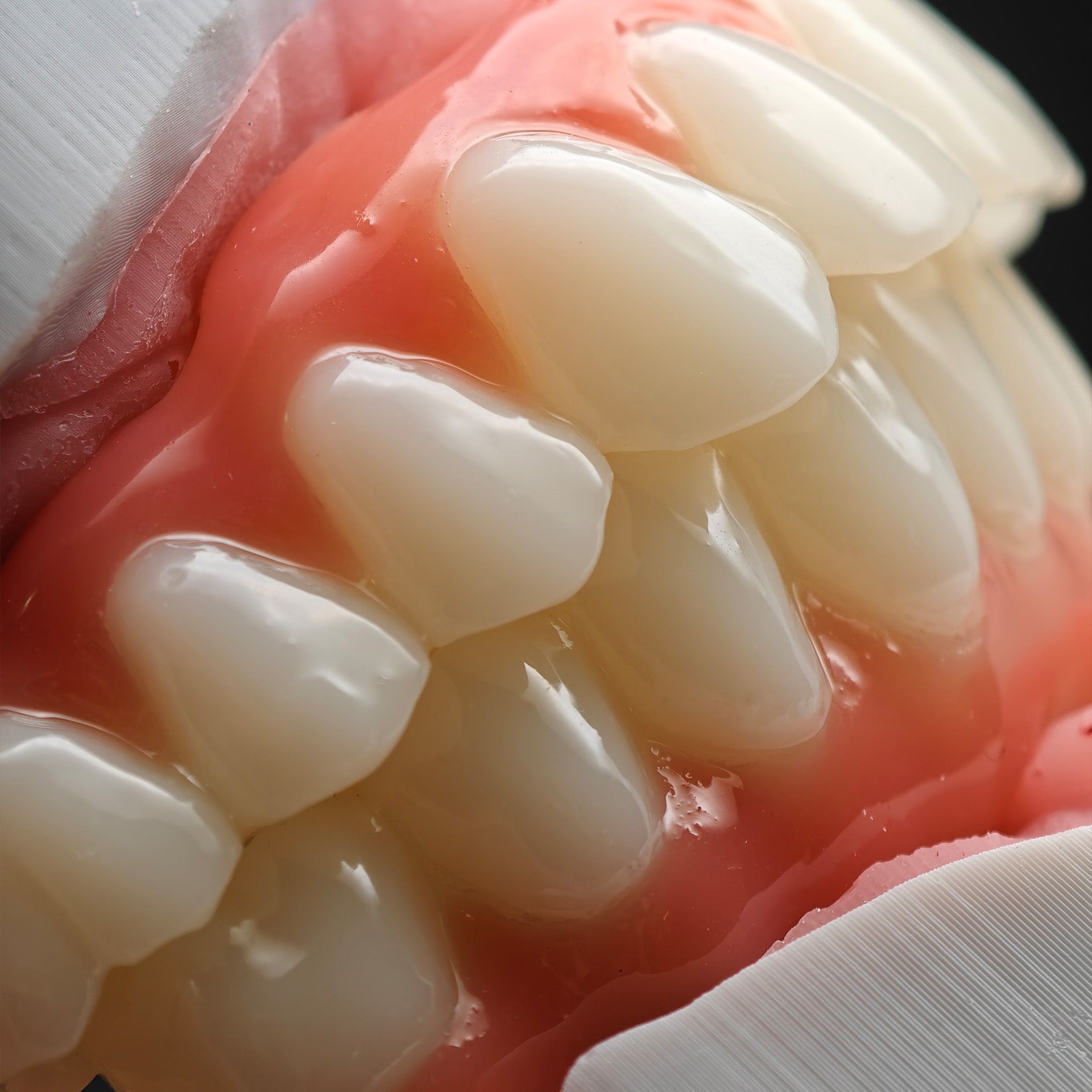 PMMA Bridge With Ti-Base Screw Retained Trying For Full Arch Restoration