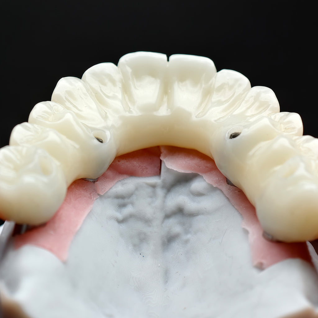 PMMA Bridge With Ti-Base Screw Retained Trying For Full Arch Restoration