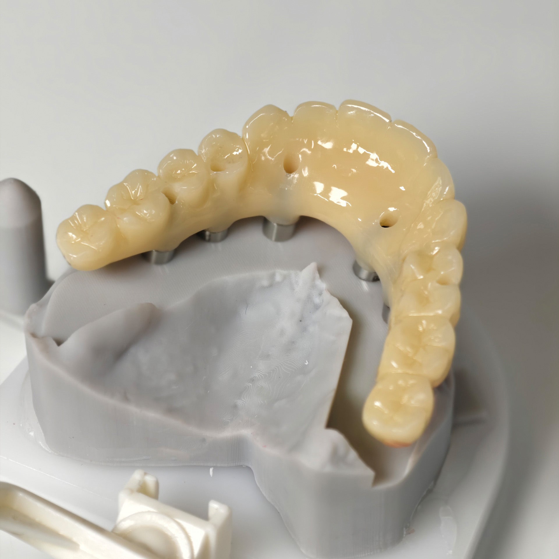 PMMA Bridge With Screw Retained