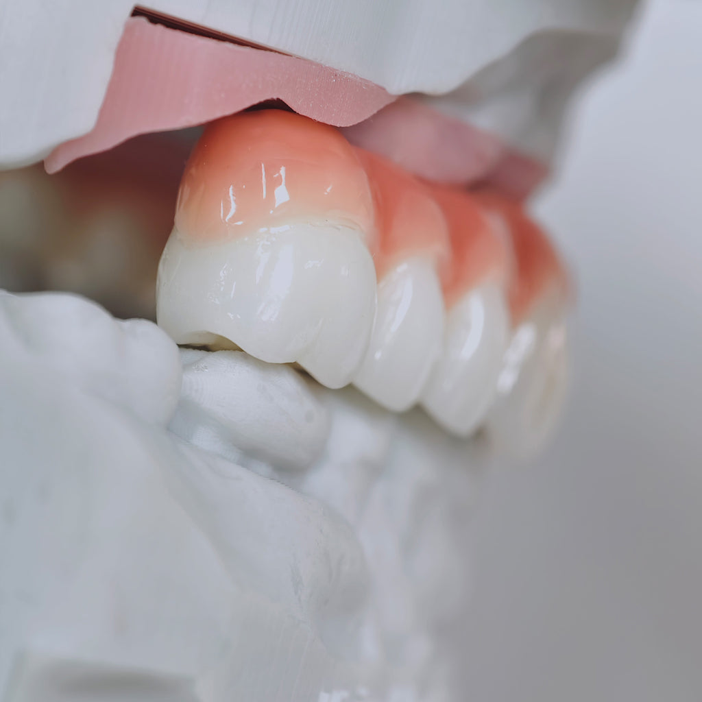 Zirconia-Enamel Hybrid Malo Bridge Aesthetic