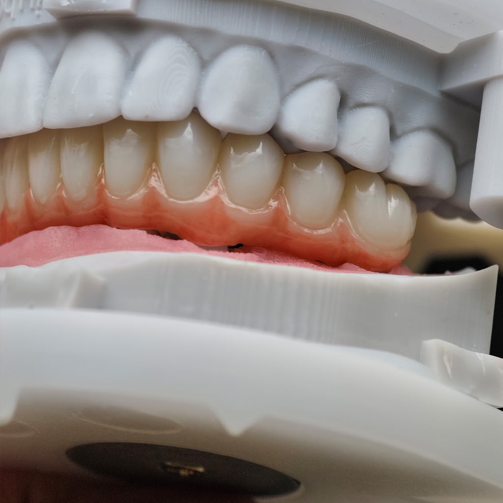 Zirconia Bridge With Cement Retained