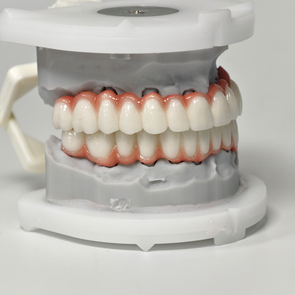 Full-Arch PFM Bridge With Screw Retained