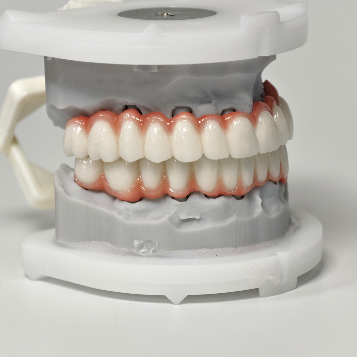 Full-Arch PFM Bridge With Screw Retained