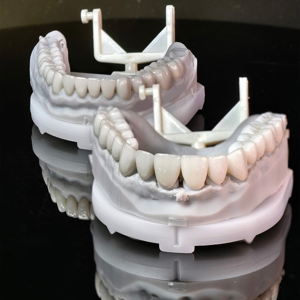 Ceramic Veneers And Crown With Cement Retained