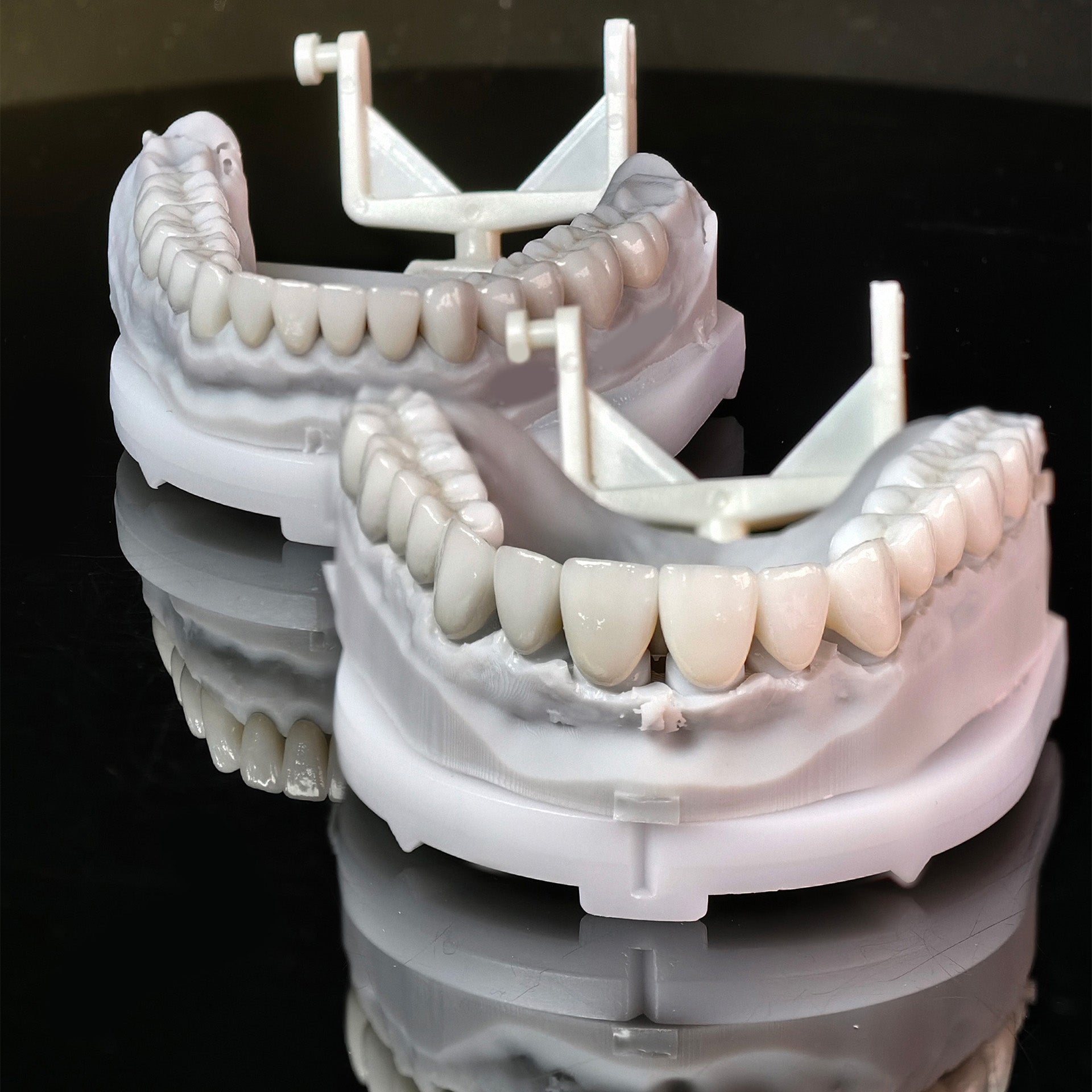 Ceramic Veneers And Crown With Cement Retained