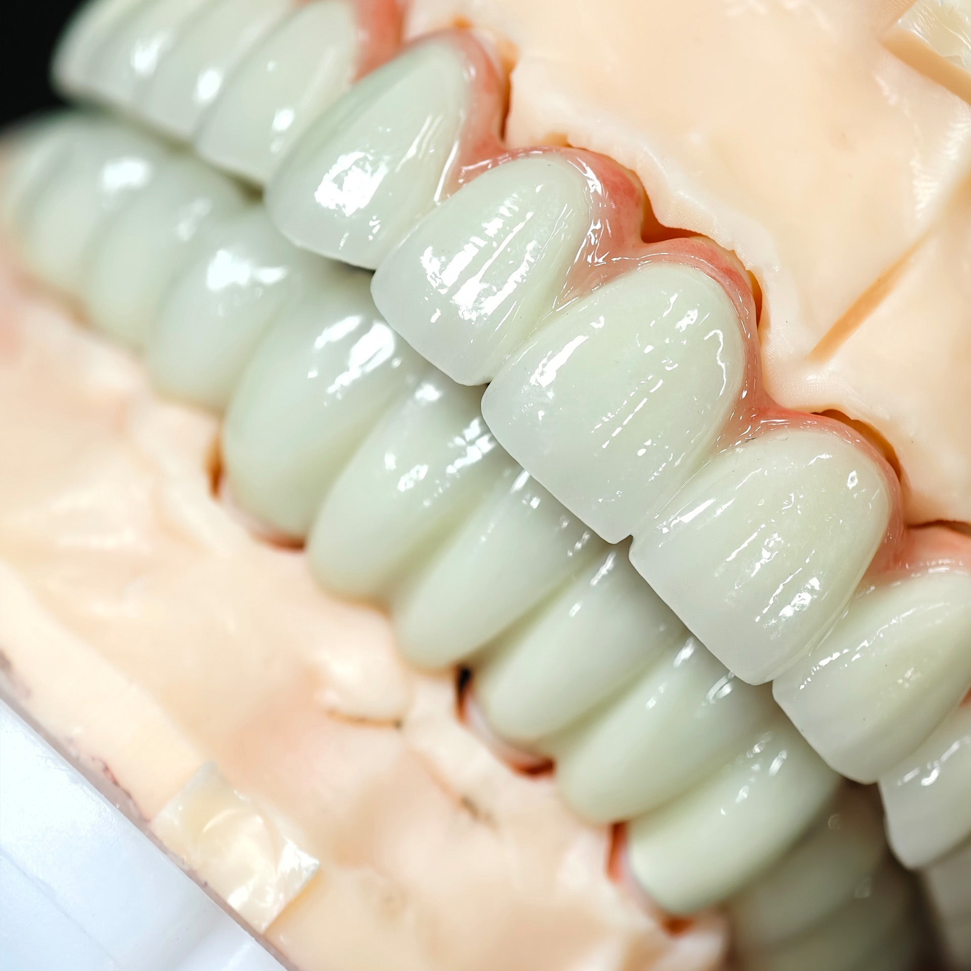 Co - Cr PFM Dental Bridge